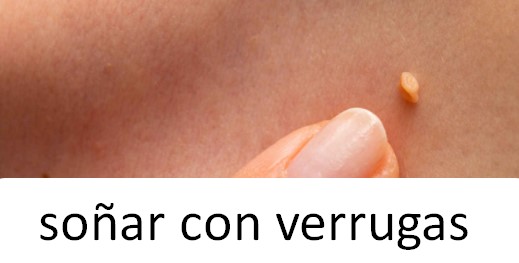 Soñar con verrugas