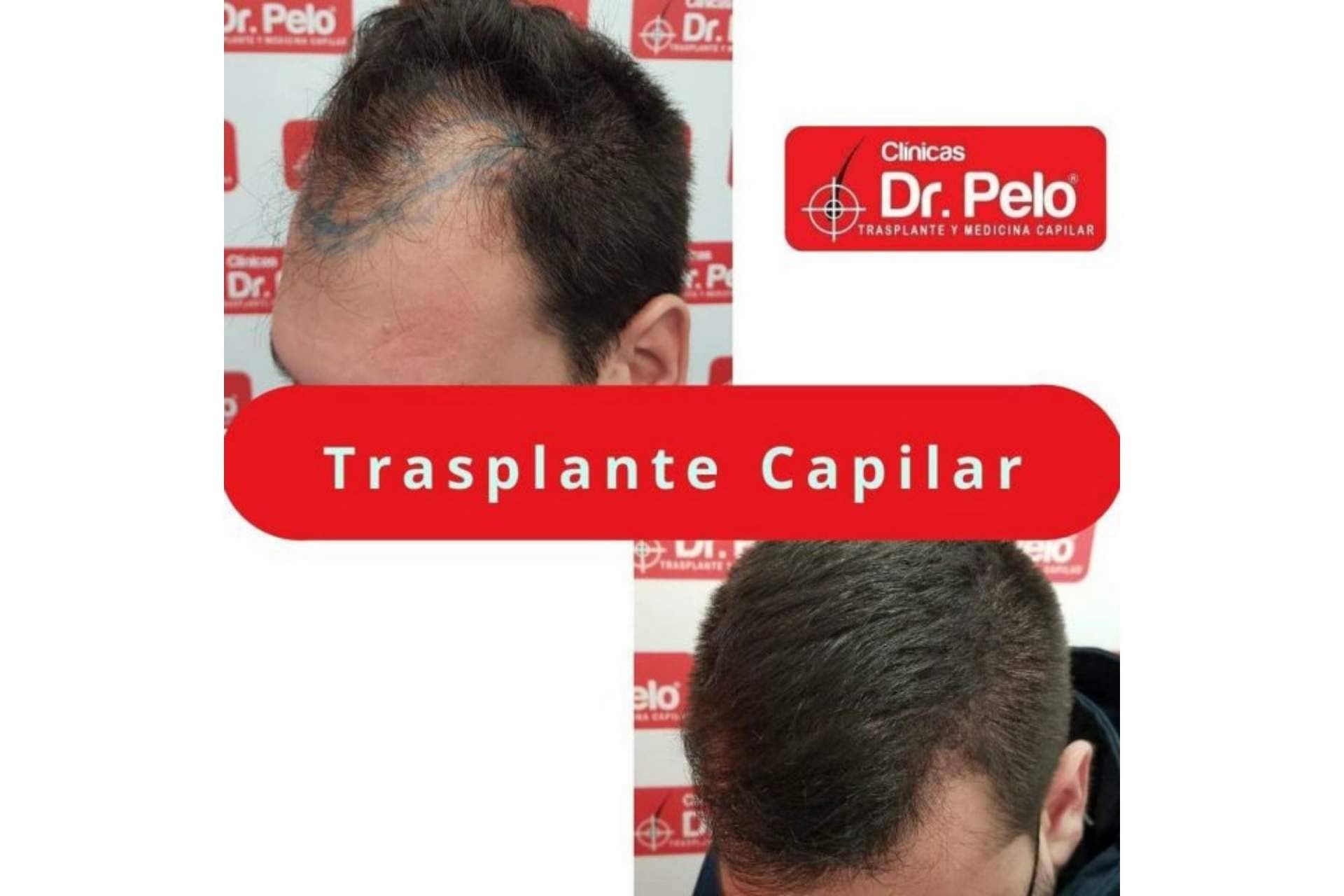 El tratamiento de injerto capilar en Sevilla gana popularidad gracias a las Clínicas Dr. Pelo