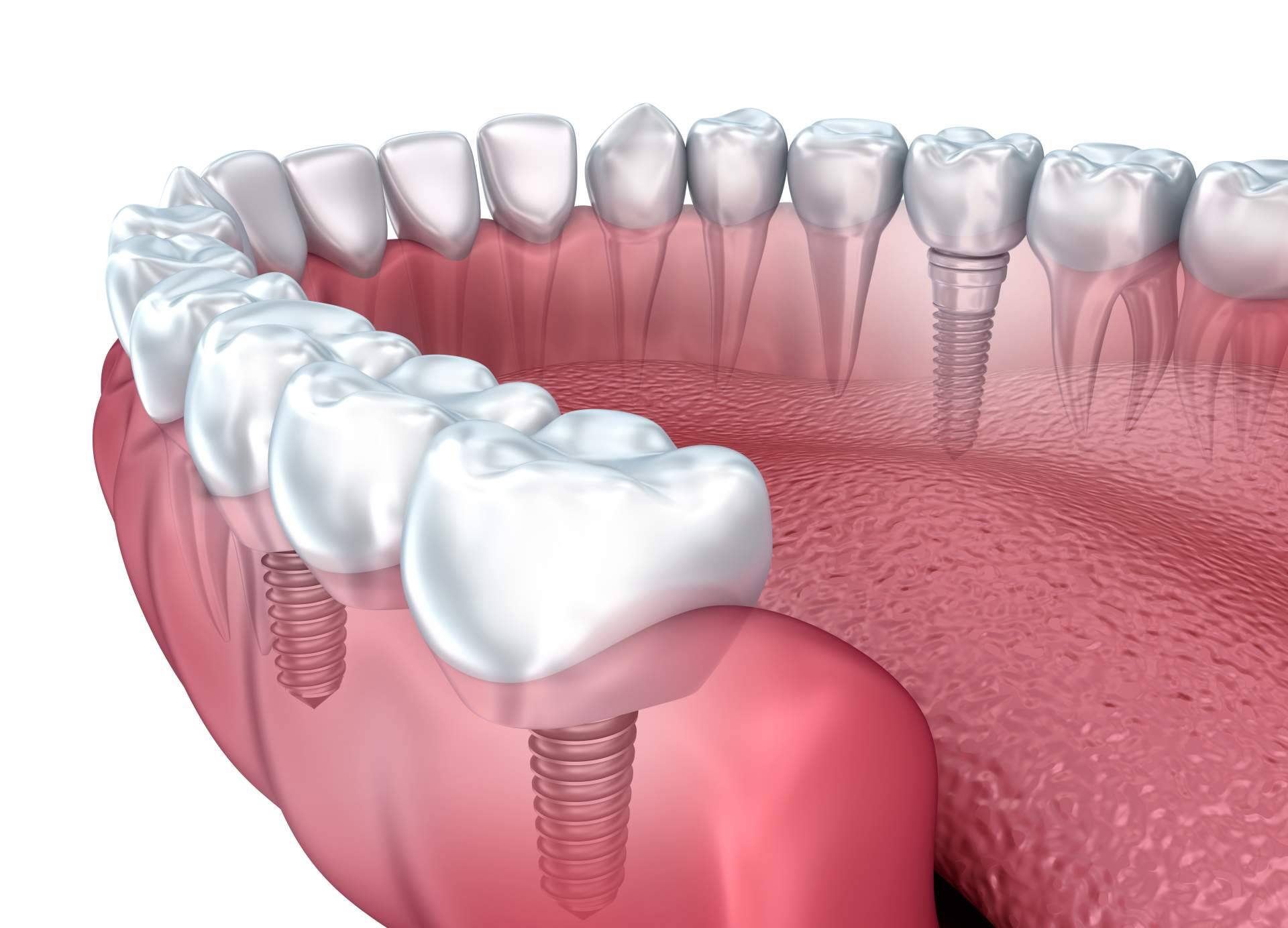 Implante dental de titanio en la Clínica de Odontología Artydents de Madrid por solo 199€