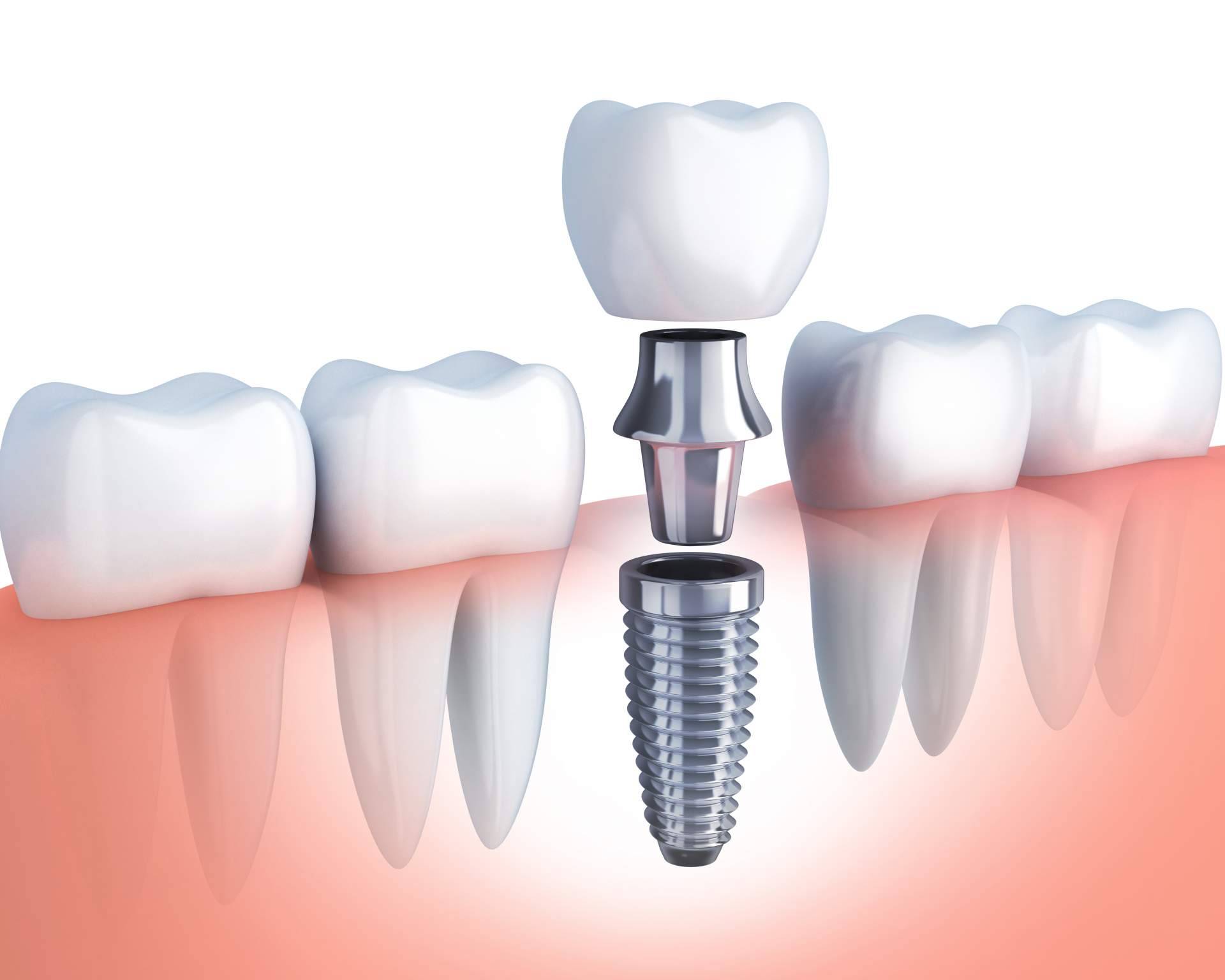 La Clínica Artydents en Madrid se consolida como la líder del sector gracias a la calidad de su implante dental de titanio V