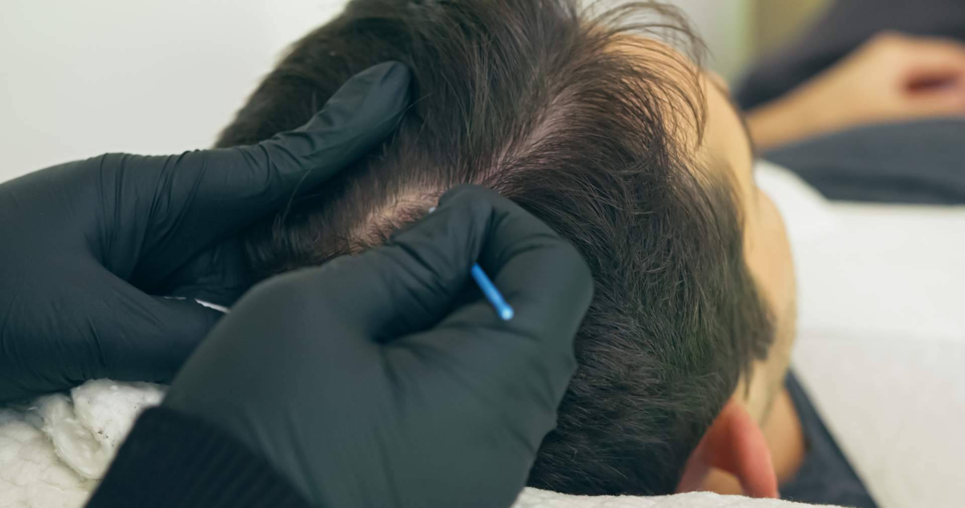 Servicios de micropigmentación capilar de la mano del centro Distrito Wellness Concept