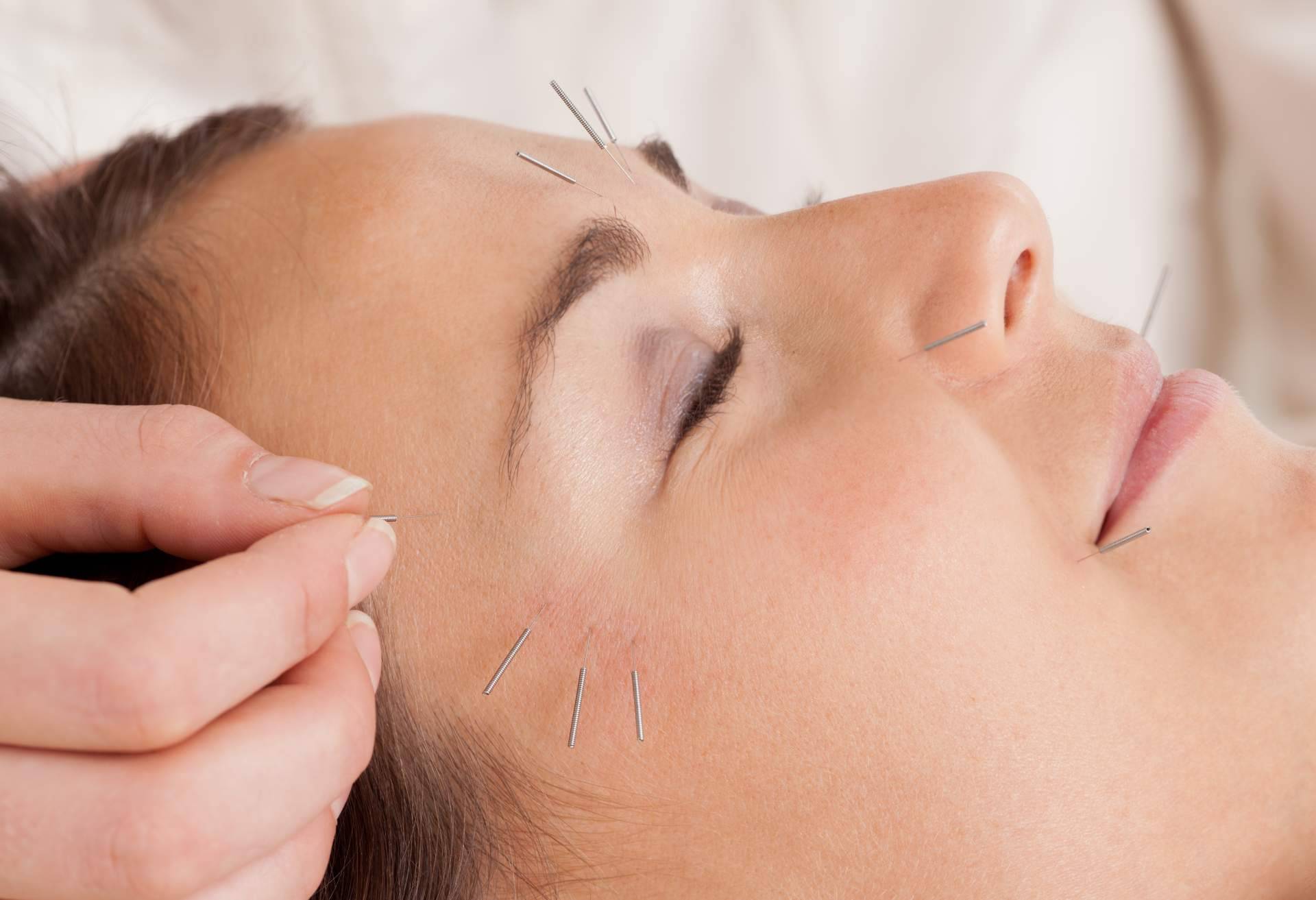 Realizar acupuntura estética a domicilio ya es posible gracias a Kikai