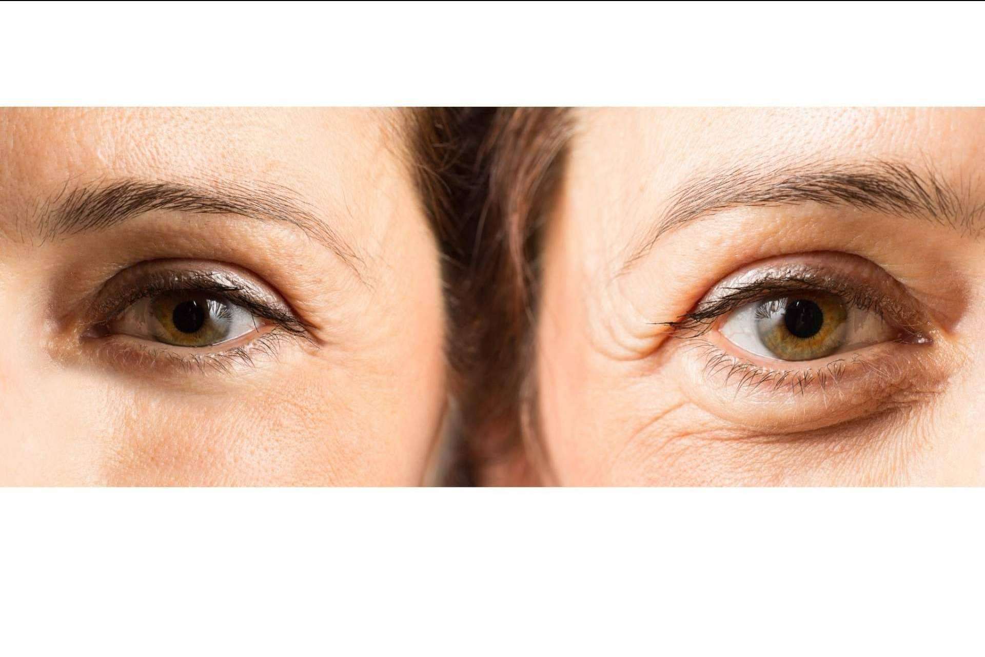 Unidad de medicina estética FEMME de Santiago de Compostela: ácido hialurónico para combatir las ojeras con la Dra. Alfonsina Uriburu