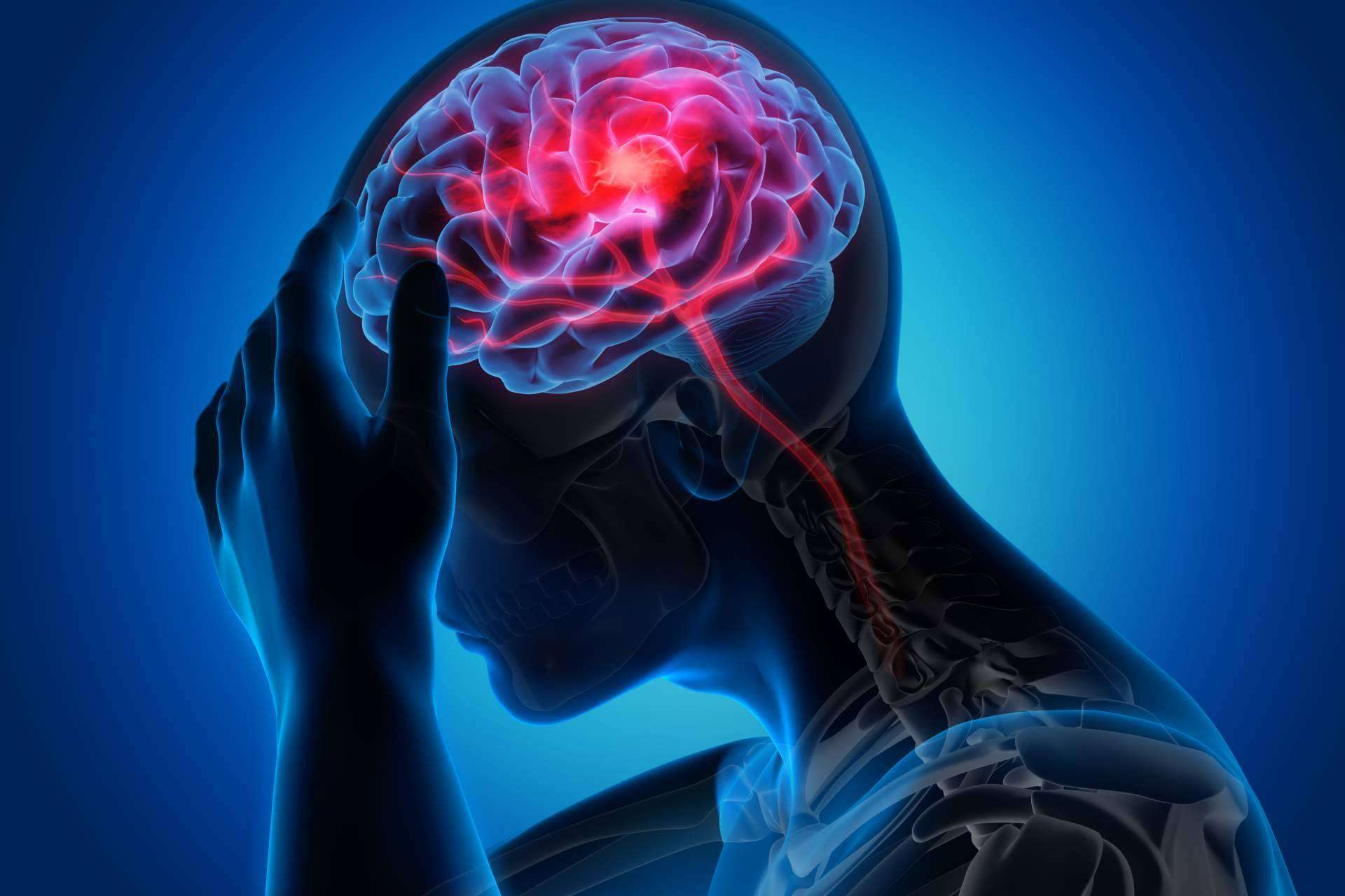 La fisioterapia puede aliviar las migrañas, por Clínica Viasalud