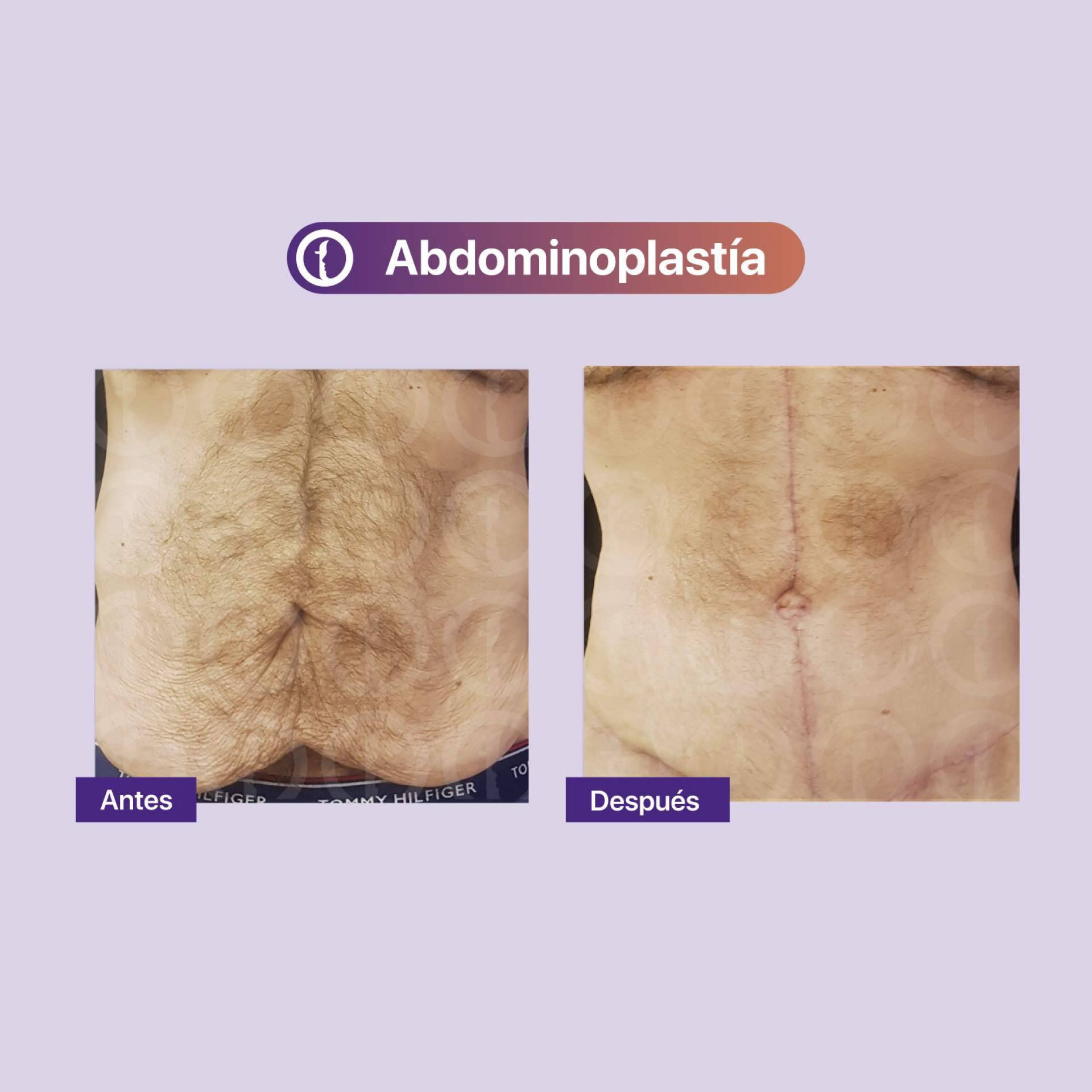La técnica de la abdominoplastia que realiza Clínica Tarrazo
