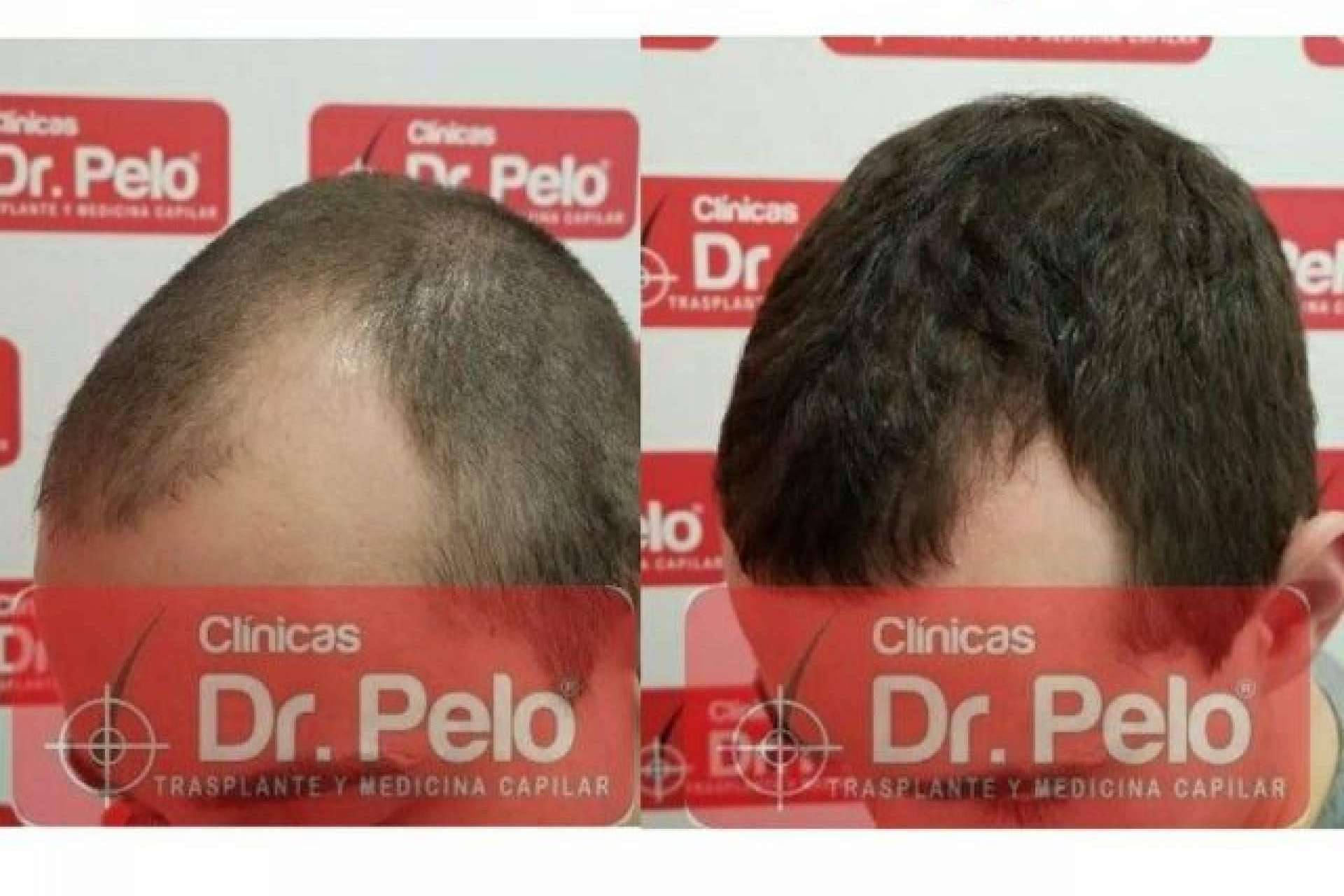 Las ventajas del láser capilar LedHair de Dr. Pelo