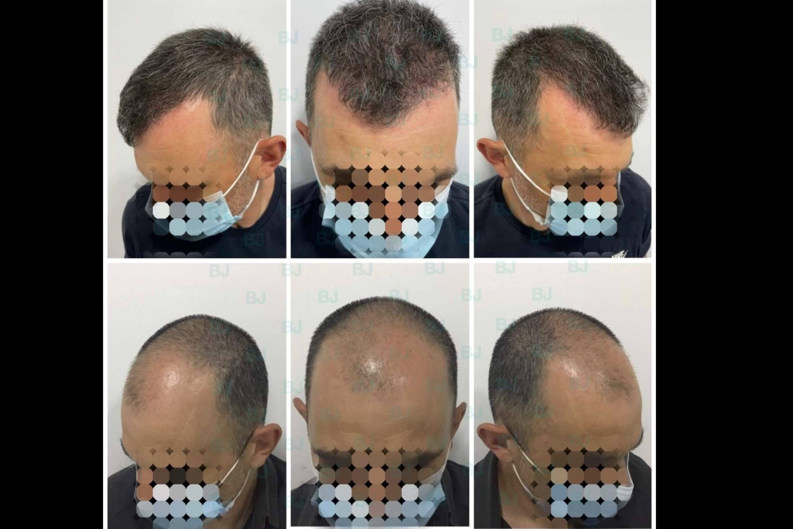 Dr. Bruno Jacobovski, especialista en injerto capilar en Barcelona con más de 500 intervenciones de éxito