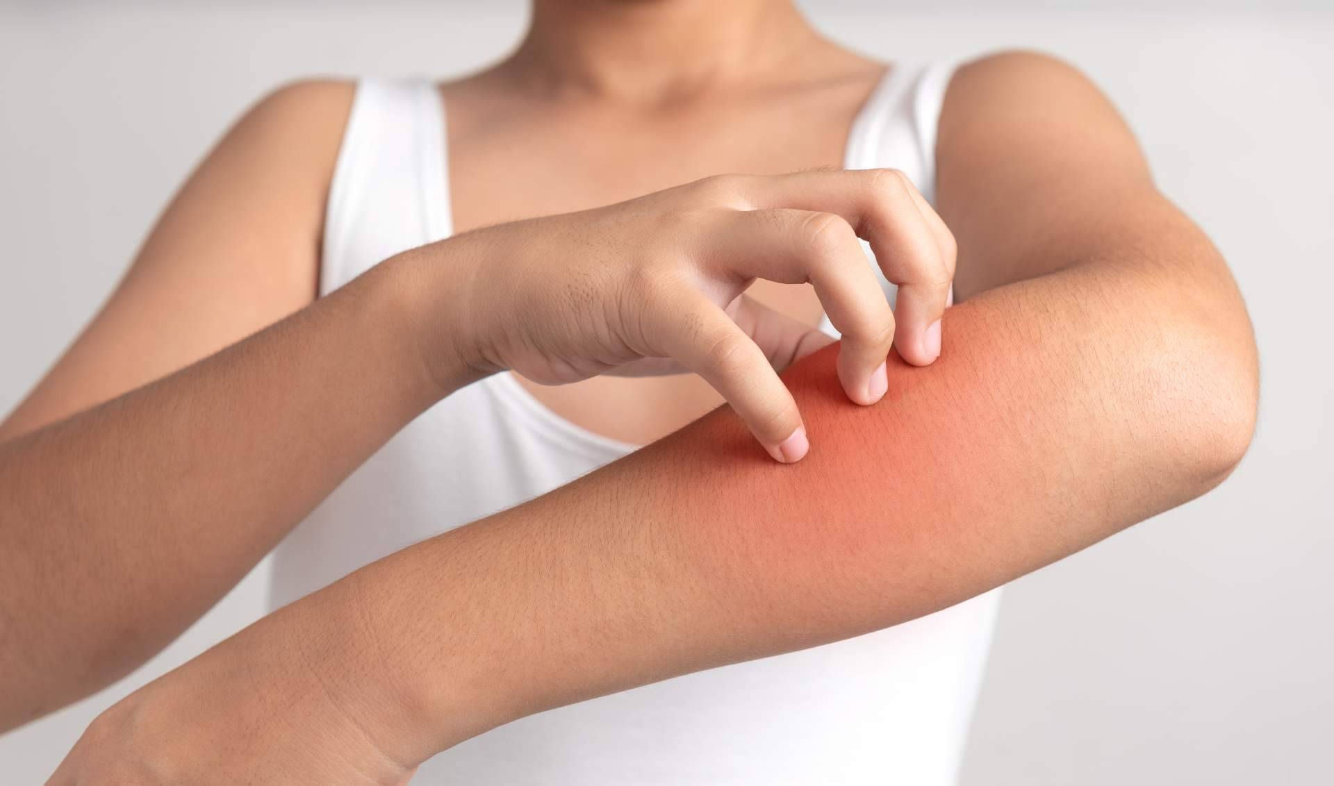 Adquirir un tratamiento natural psoriasis corporal sin cortisona en Laboratorio Géomer