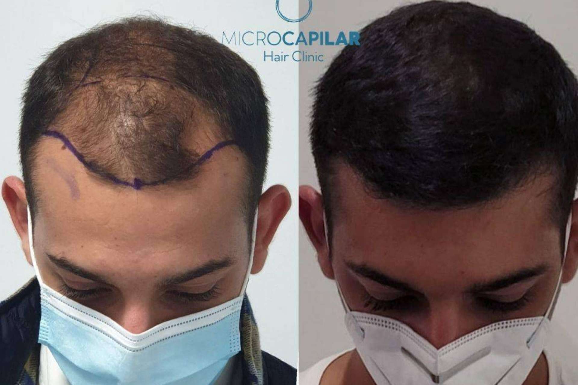 El injerto capilar con máxima extracción folicular se puede realizar en lugares especializados como Microcapilar Hair Clinic