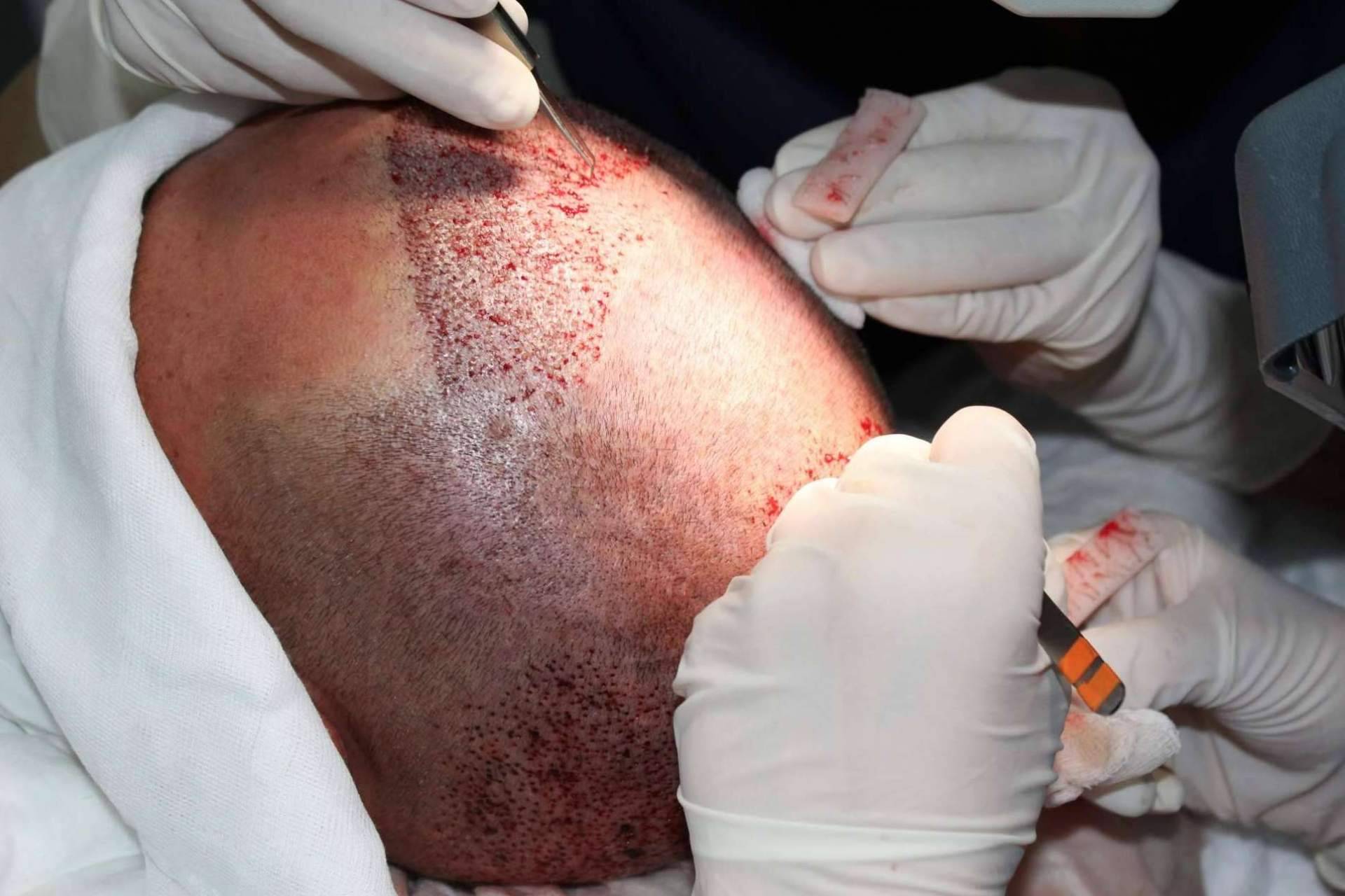 Las ventajas de recurrir a Injerto Capilar en Murcia