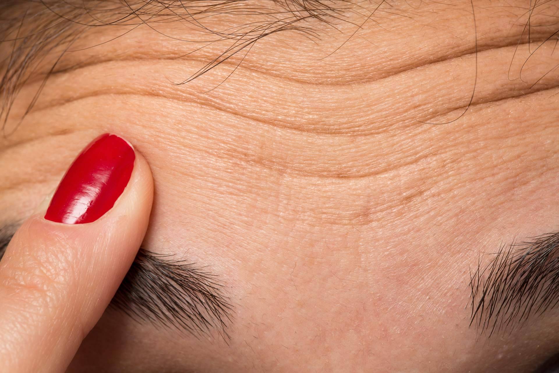 La Clínica de Medicina Estética Sánchez Peral en Castellón lleva a cabo diseño de cejas con bótox