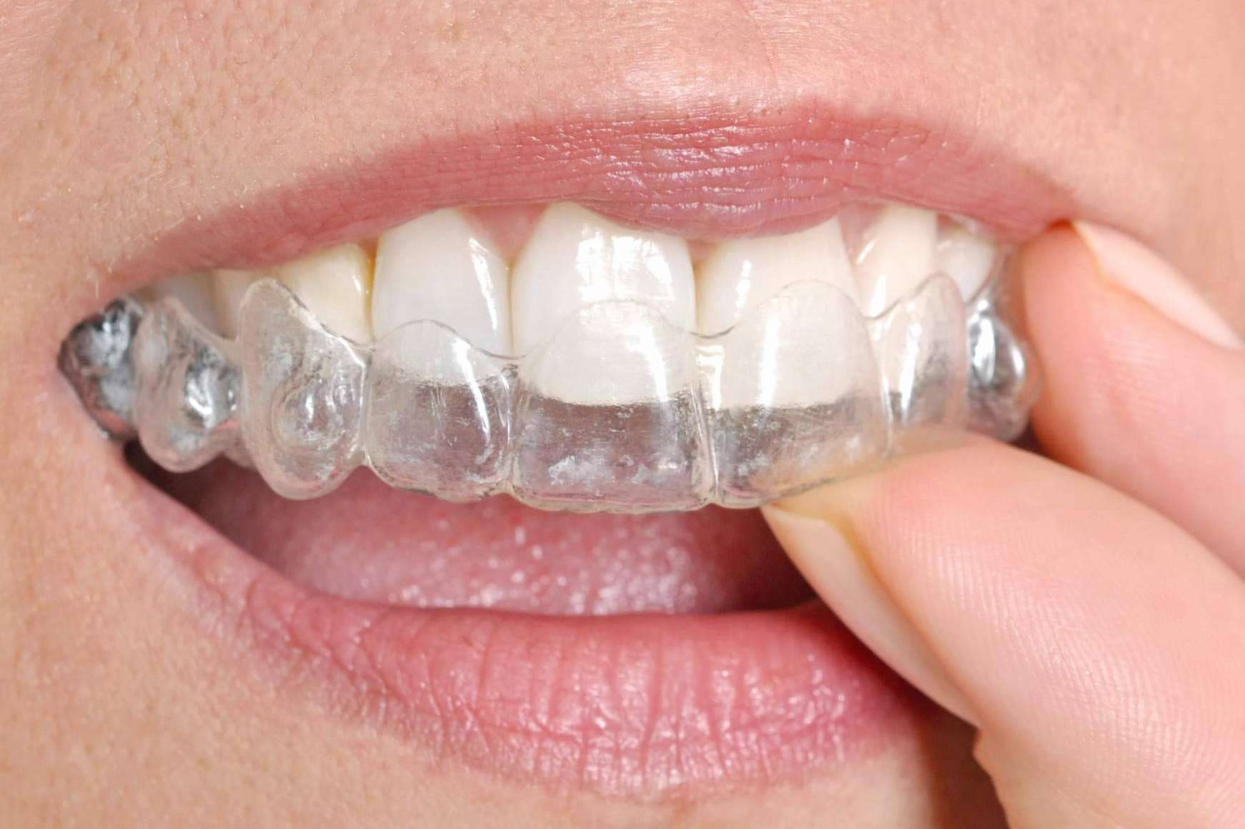 El Certificado de Calidad DentalQuality® sirve para distinguir los centros recomendados con servicios de ortodoncia invisible