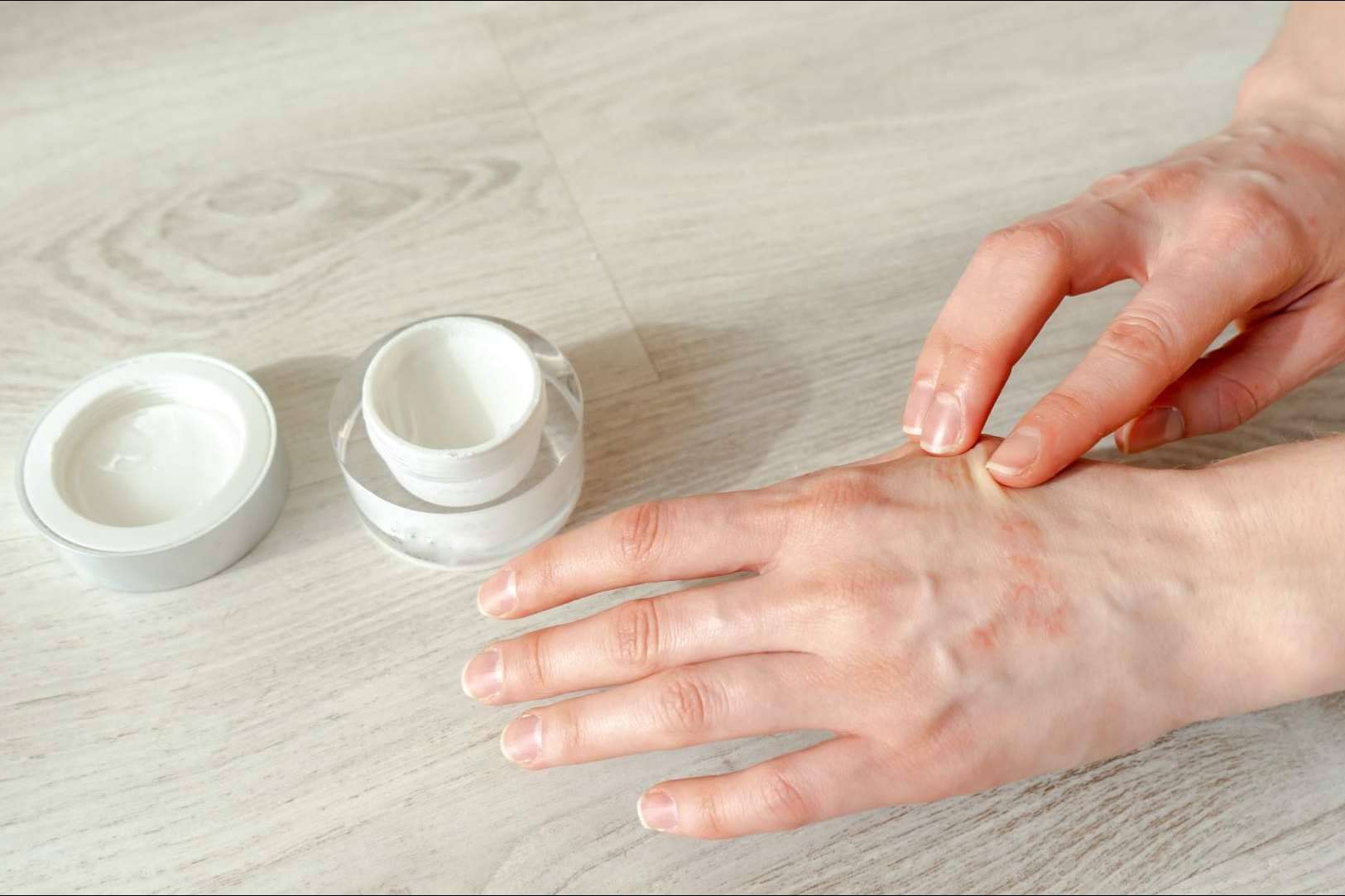 ¿Cómo se diferencia un eczema atópico de un eczema de contacto?, por Laboratorio Géomer
