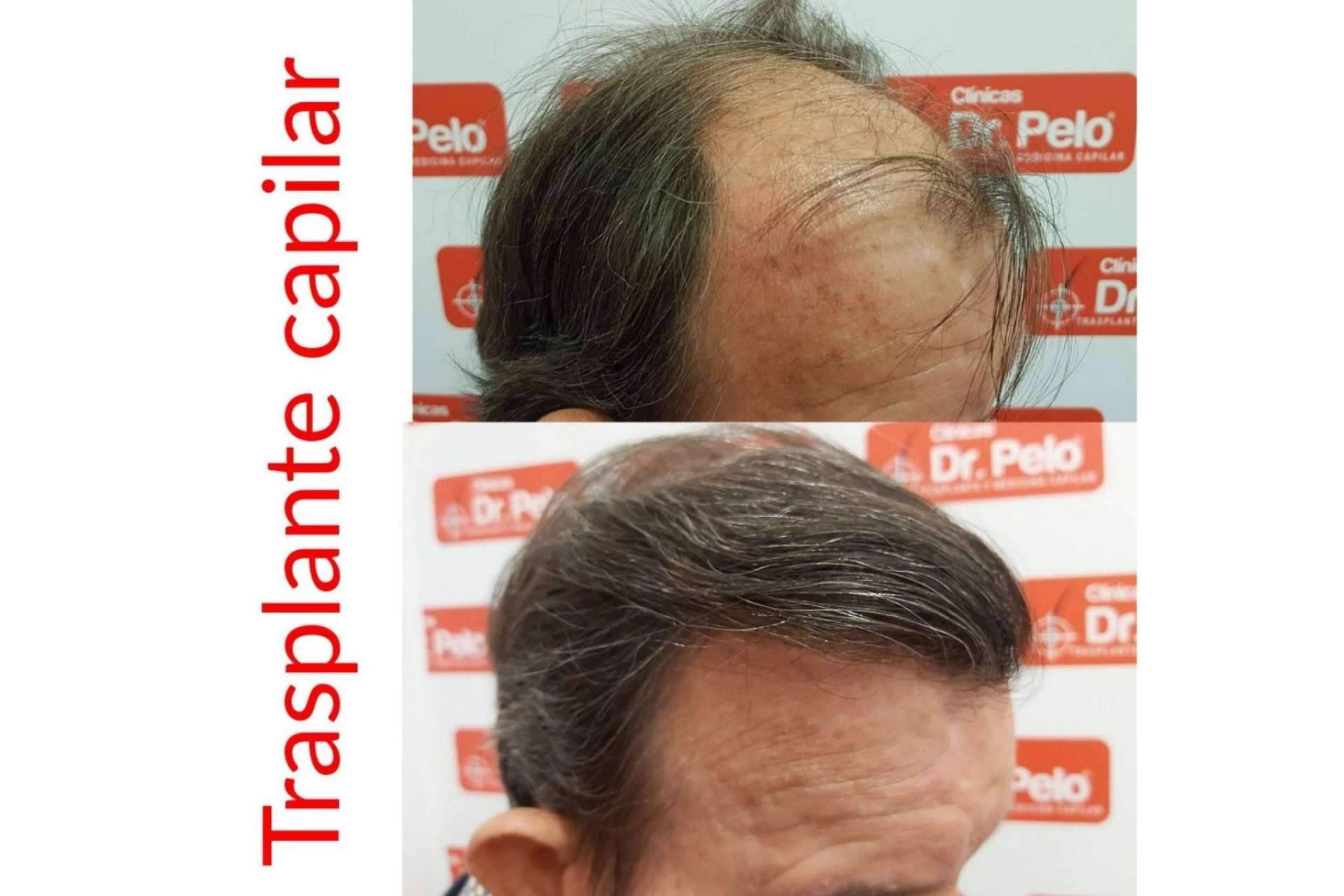 Para realizar la Técnica Progresiva Capilar, Dr. Afonso Junior ofrece una primera cita online gratuita