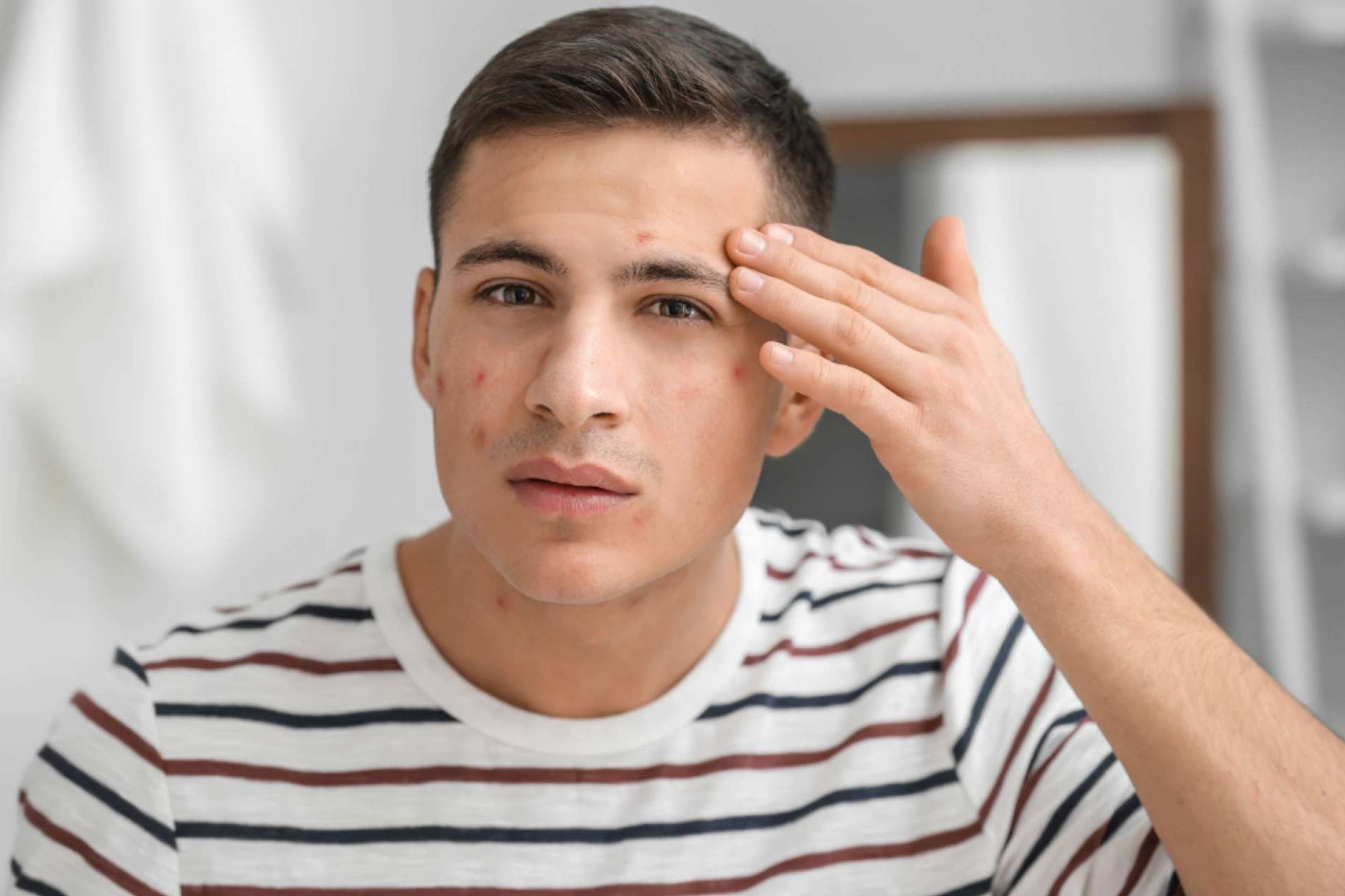 Bėyo Beauty dispone de un tratamiento contra el acné que brinda muchos beneficios