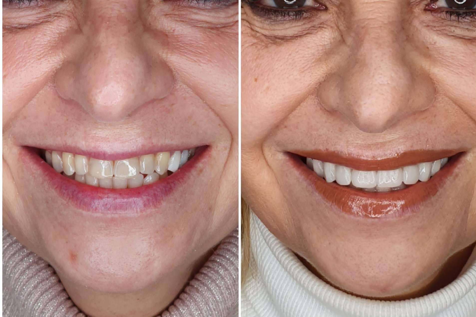 Estética dental en 2 visitas, con Dentinova