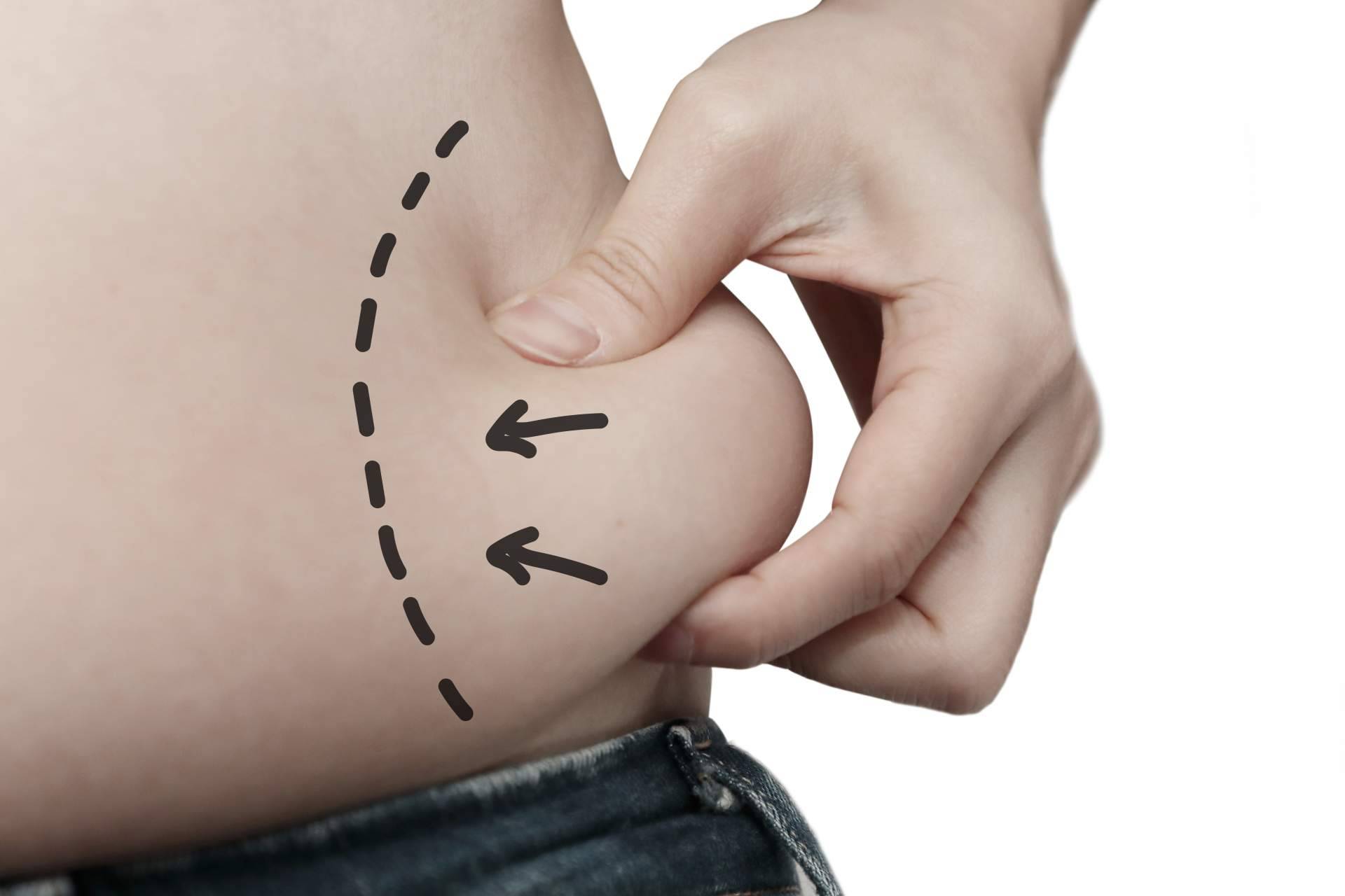 Los beneficios del tratamiento de Velashape III de la Dra. Rigo
