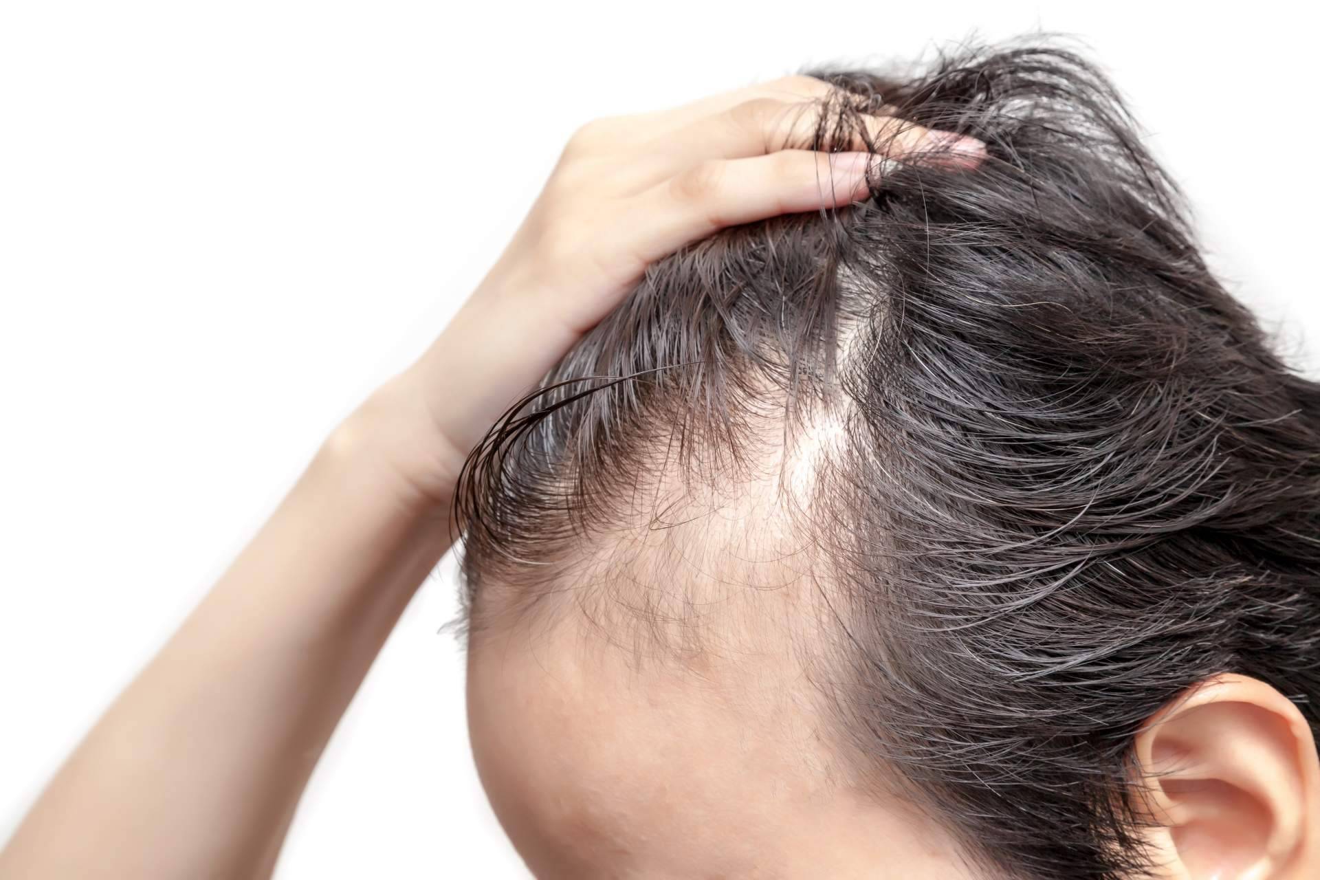 Saw Palmetto para tratar la alopecia androgénica