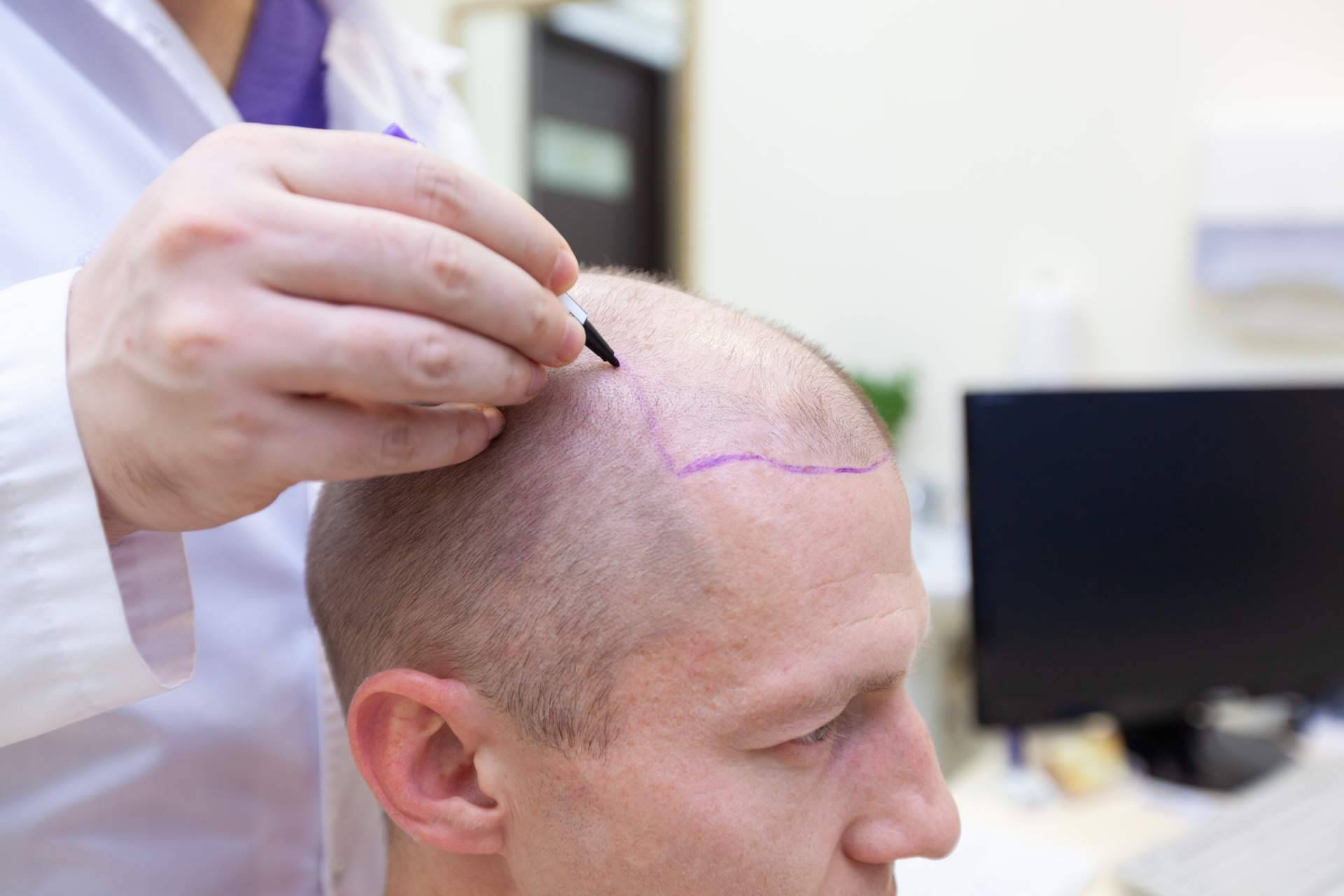 Combatir la alopecia con injertos capilares efectivos de la mano de Élite Capilar