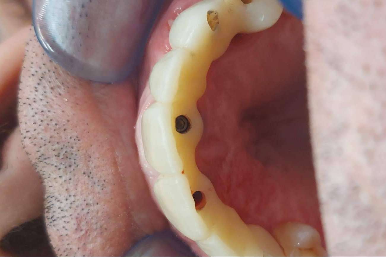Realizar implantes dentales en un día es posible con la tecnología digital de Dentinova