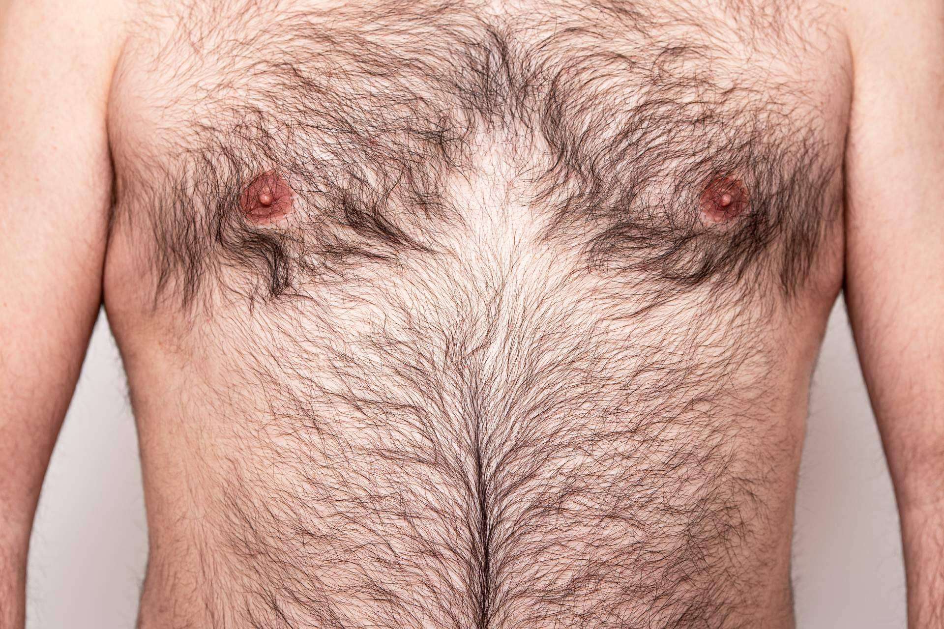 Body Hair, injerto capilar desde otras zonas del cuerpo para alopecia avanzada