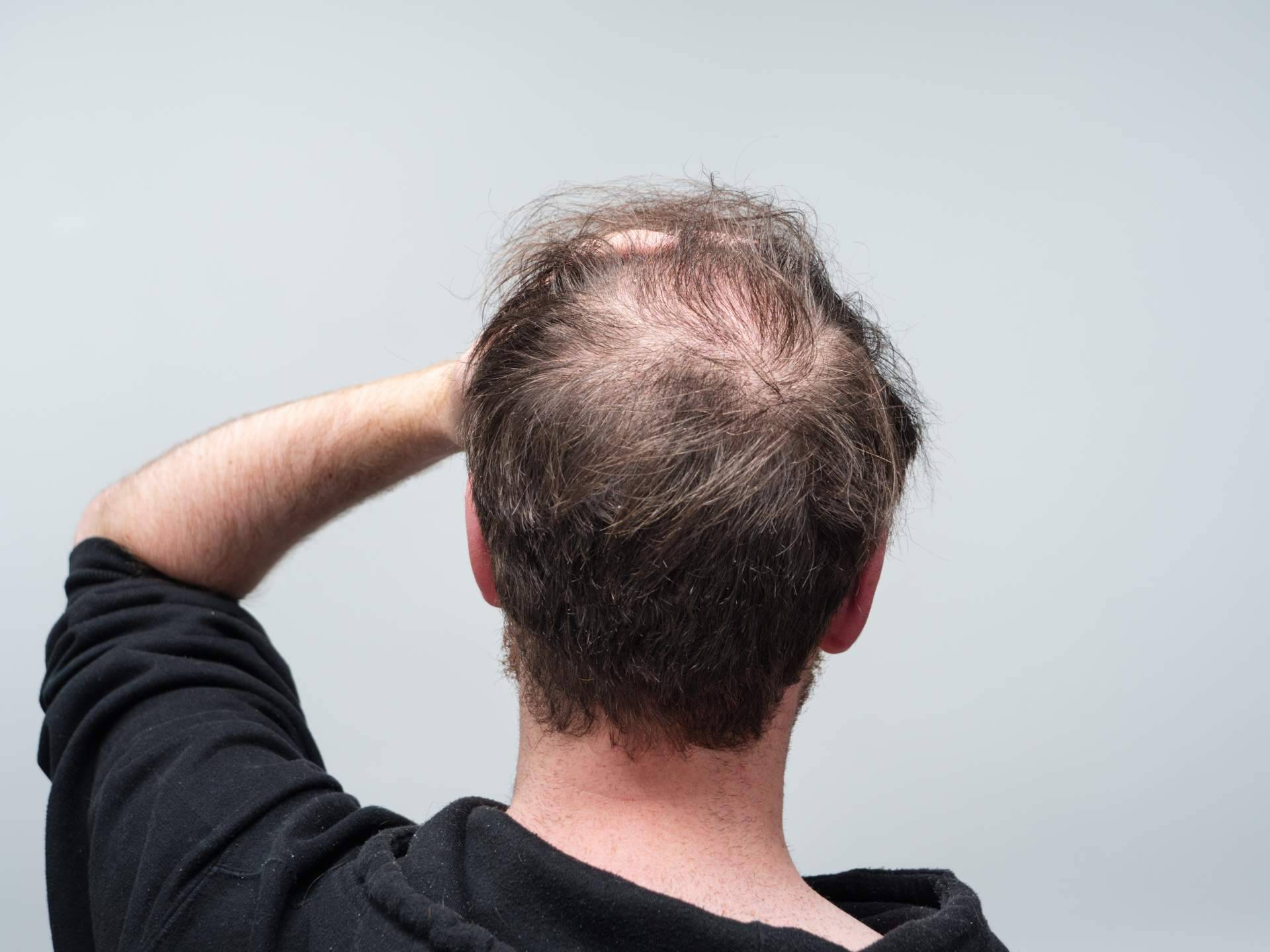 ¿Qué tipos de caídas del pelo existen?, por el Laboratorio Géomer