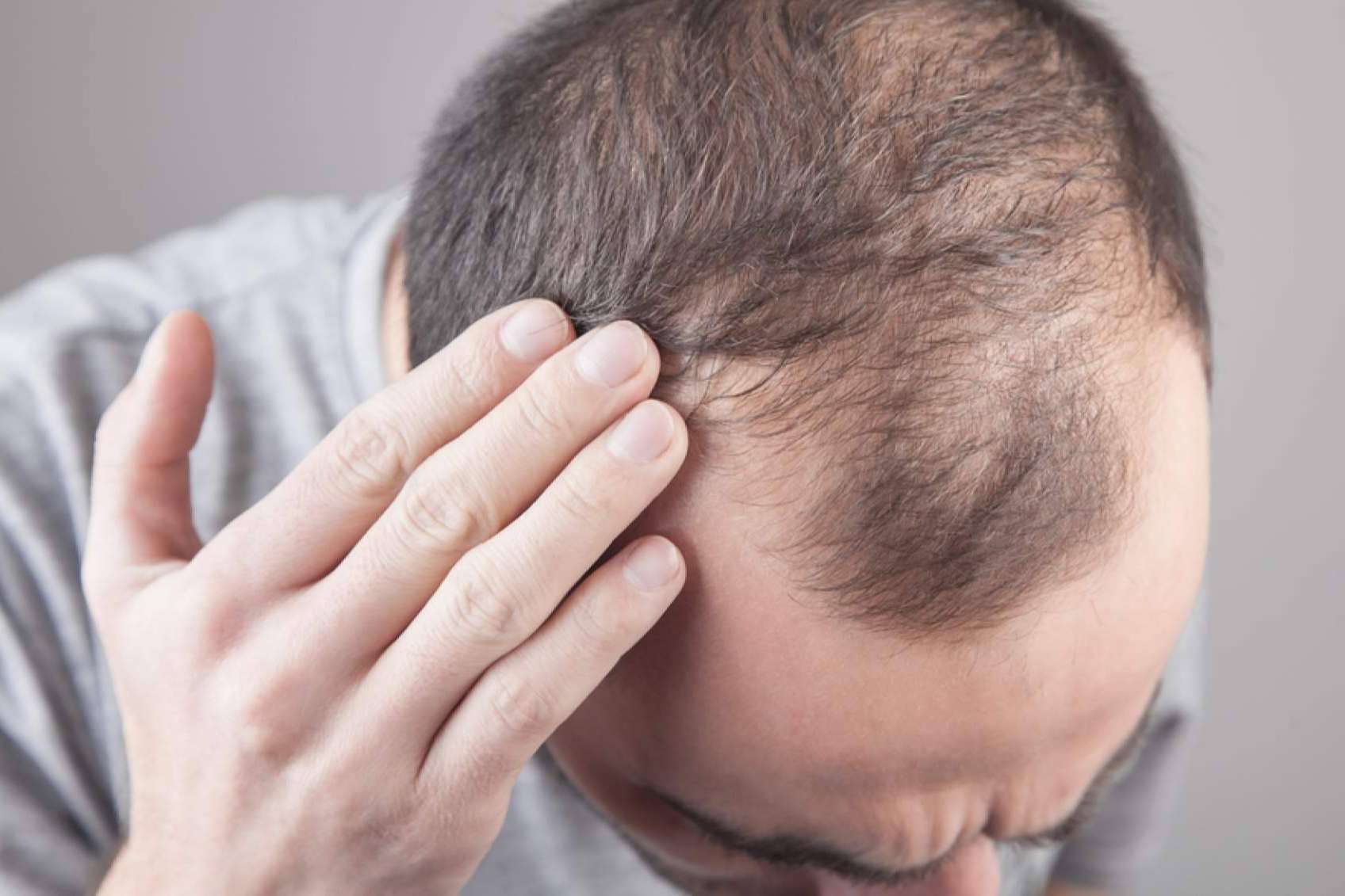 Xpecia Tablet, una alternativa para combatir la alopecia de la mano de Saw Palmetto
