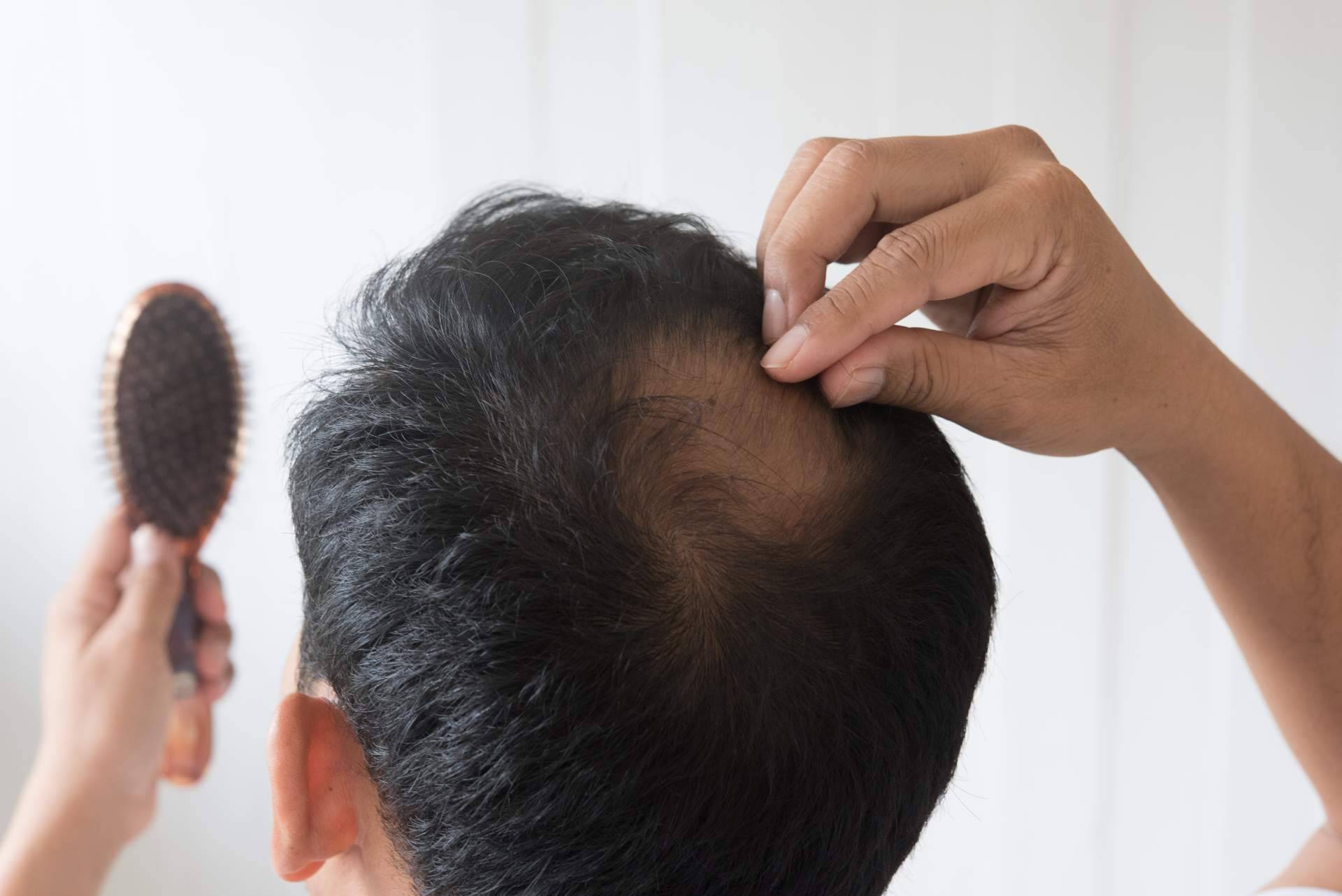 Injerto capilar sin cicatrices en Clínicas Be