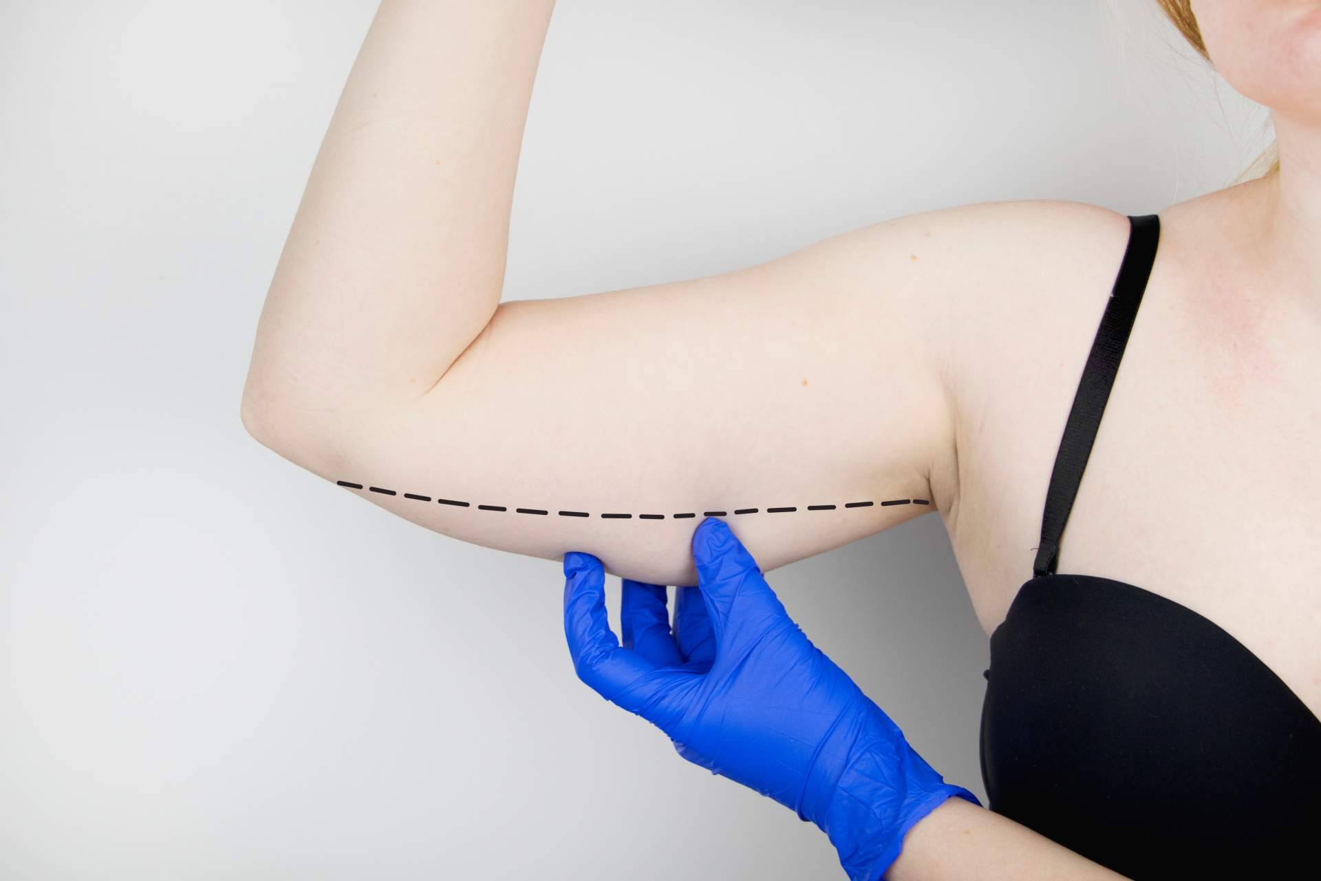 BioSalud Canarias y los tratamientos de cryolipoescultura