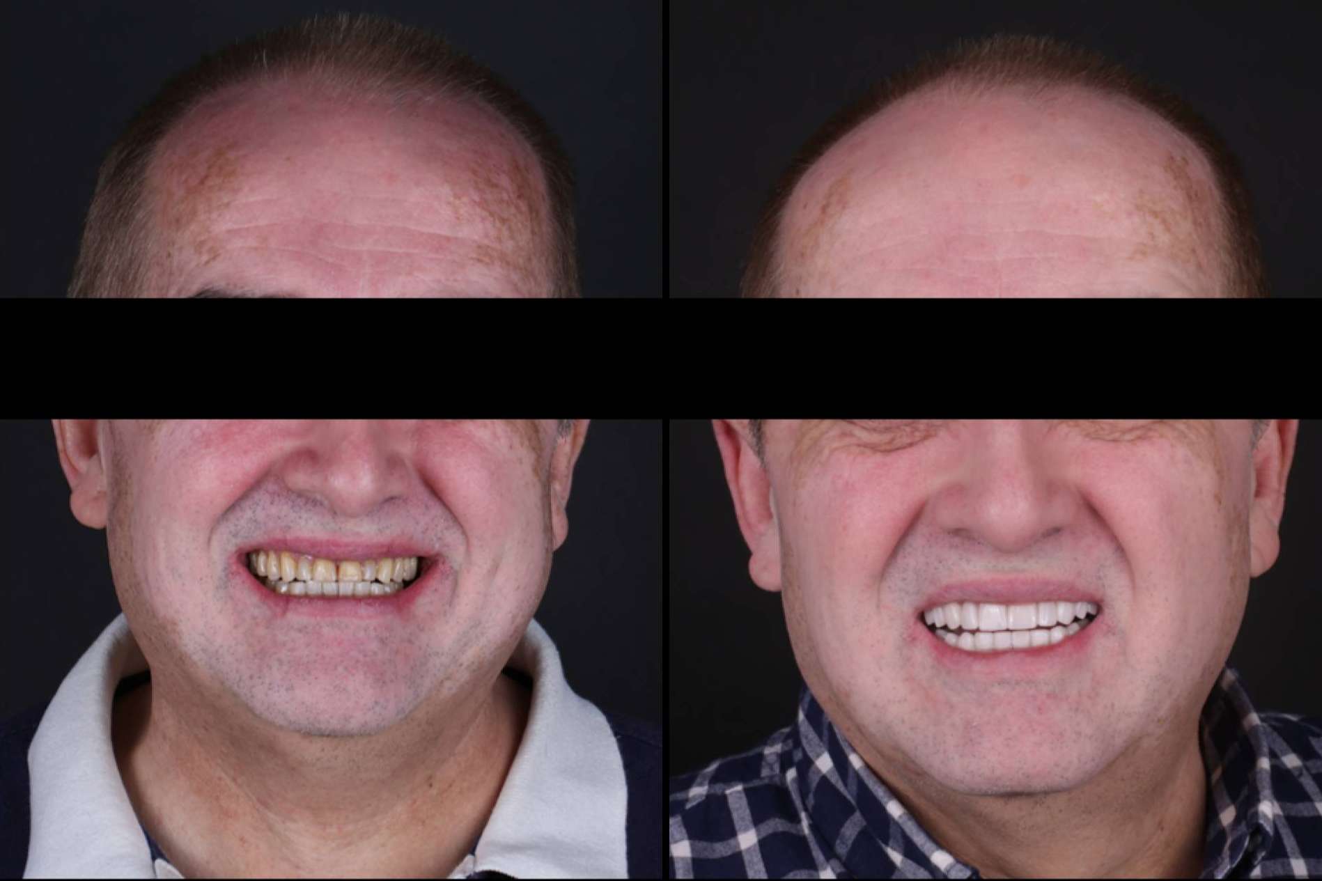 ¿Cuáles son las ventajas de las carillas dentales?, por los profesionales de Carillas Wikend®
