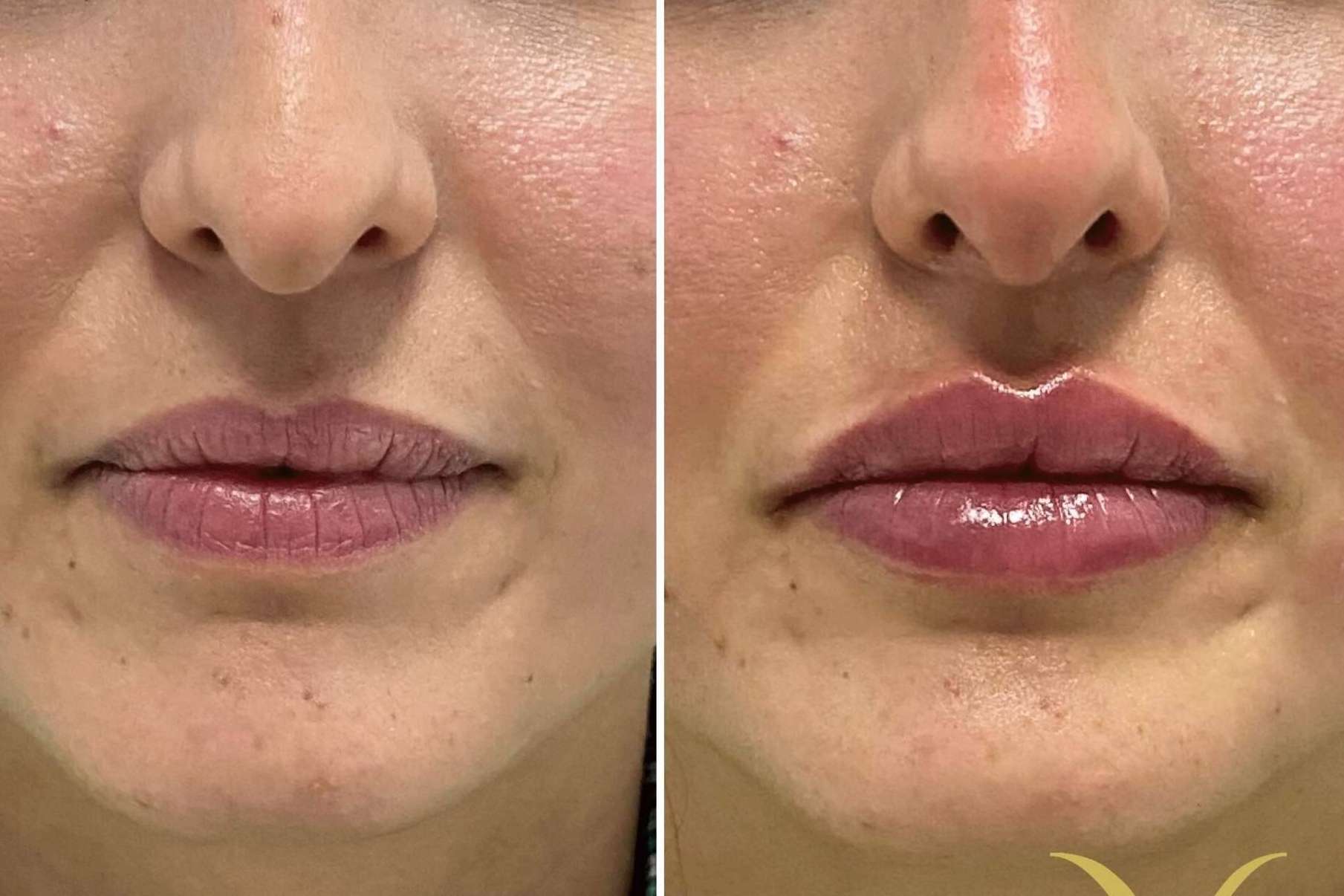 Adiblips, la técnica de la Clínica Yasmin para el aumento de labios con ácido hialurónico