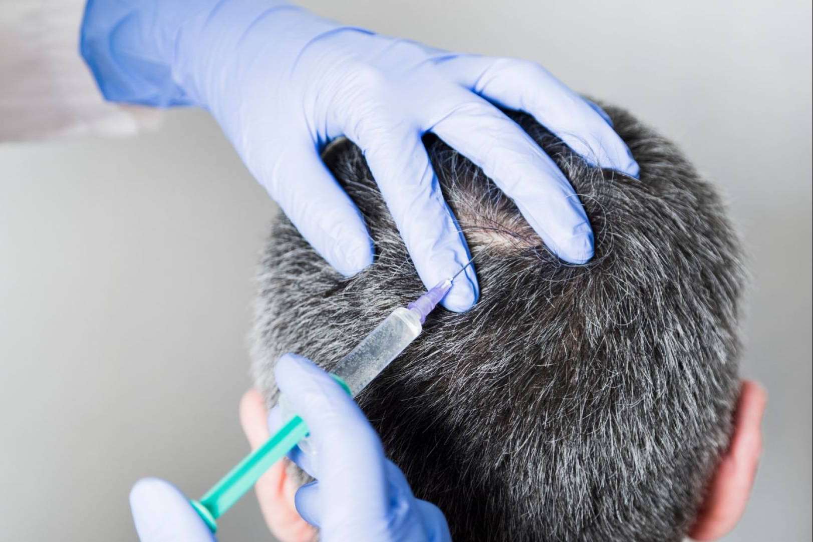 ¿Cuáles son los diferentes tipos de alopecia?, por la Clínica Capilar Laura Agrelo