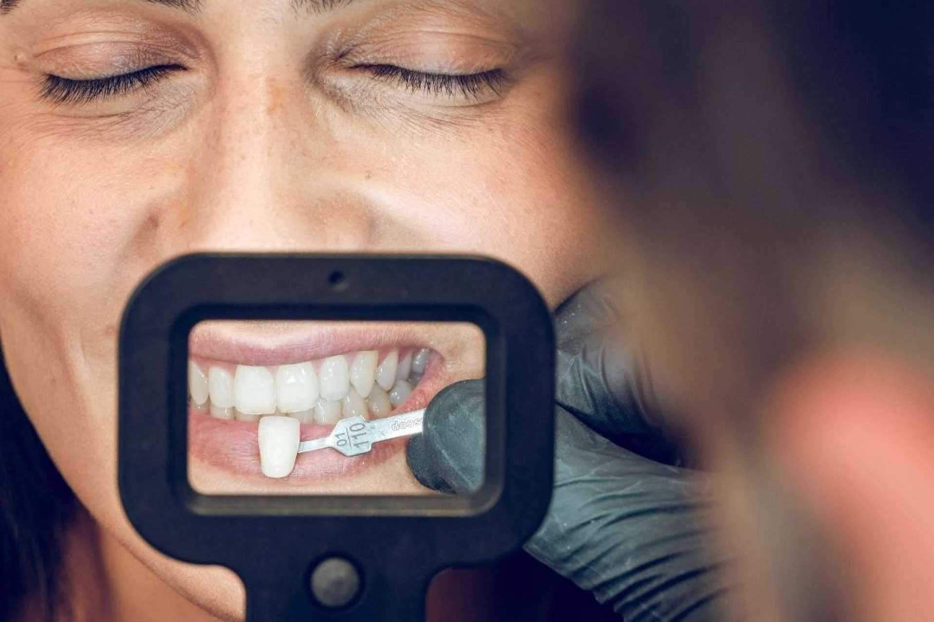 Soluciones en un día para recuperar la sonrisa, las carillas dentales