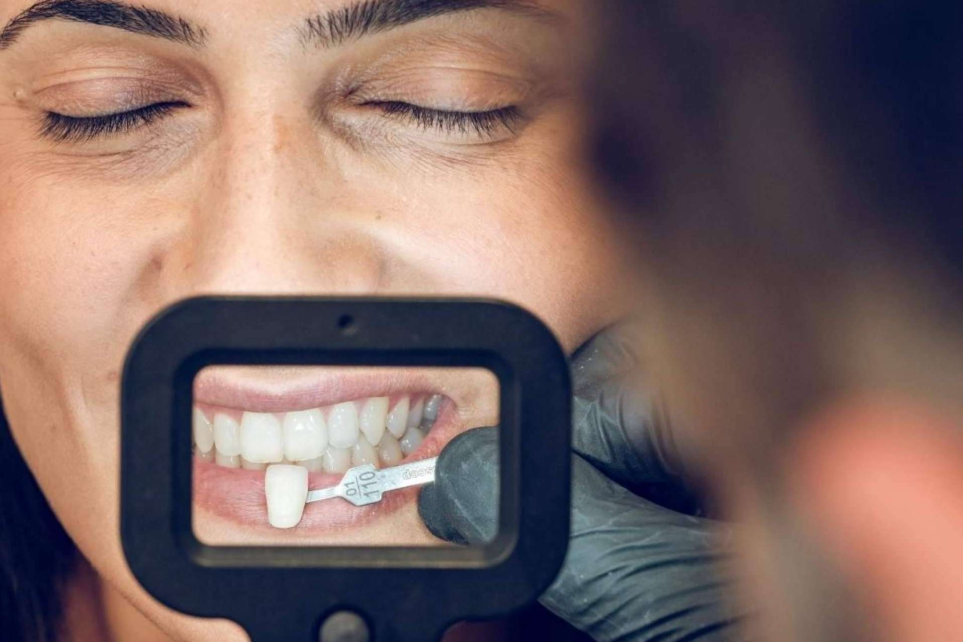 Todo acerca de las carillas dentales, por Crespí & Gandía
