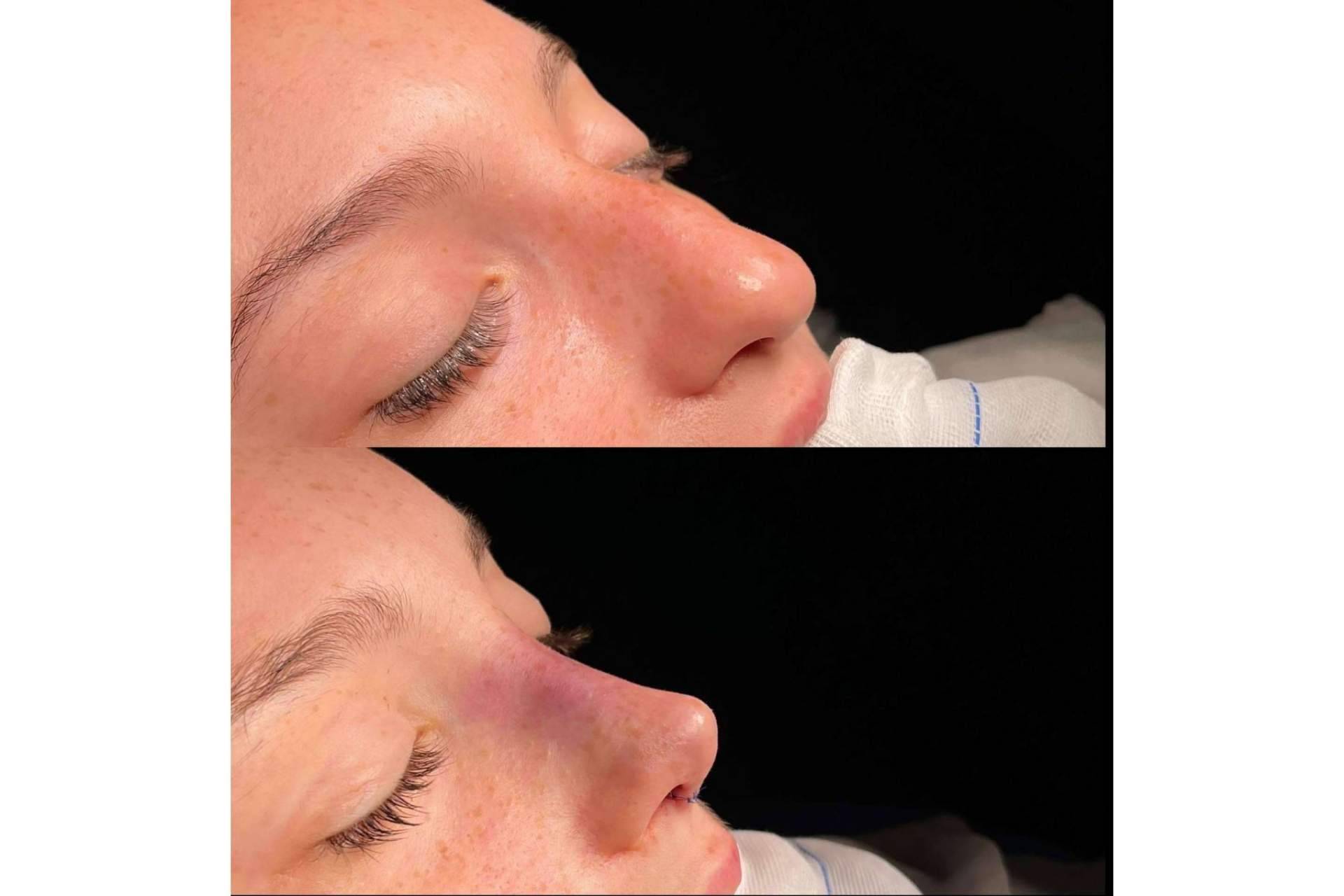 Los diferentes tipos de rinoplastia y los aspectos más importantes a la hora de elegir, de la mano del Dr. Álvaro Pérez-Villar