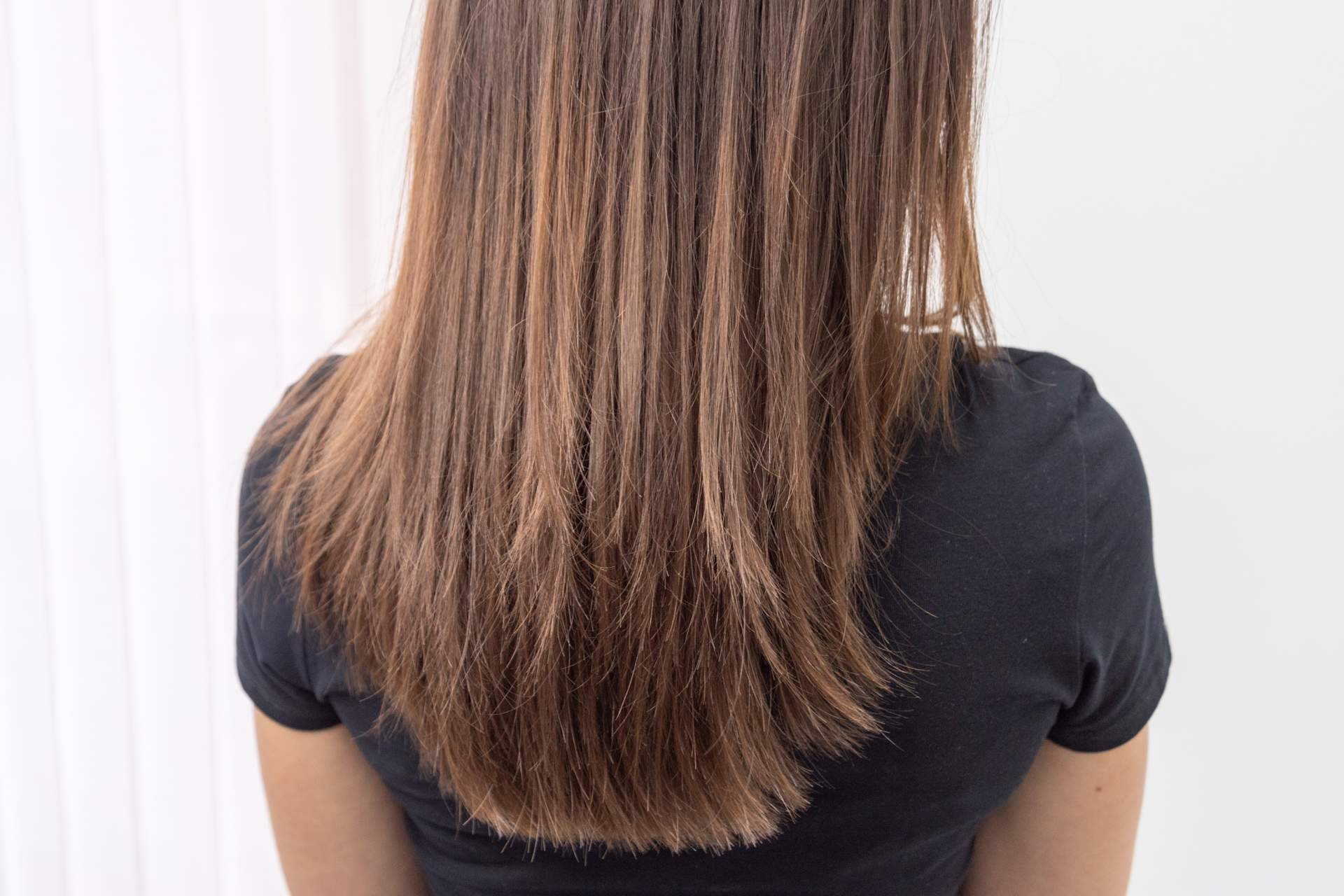 Alopecia e injerto capilar en mujeres, de la mano de MC360