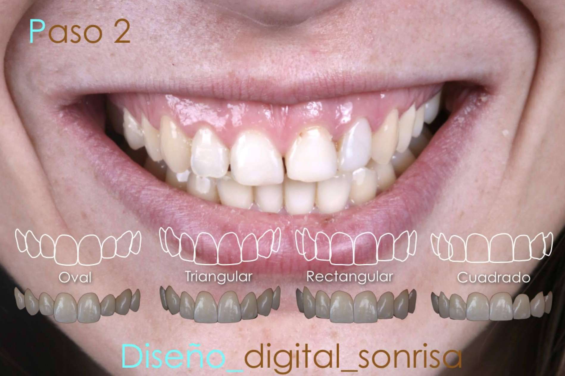 Razones para realizarse un diseño de sonrisa en la Clínica Dental Ruiz de Gopegui