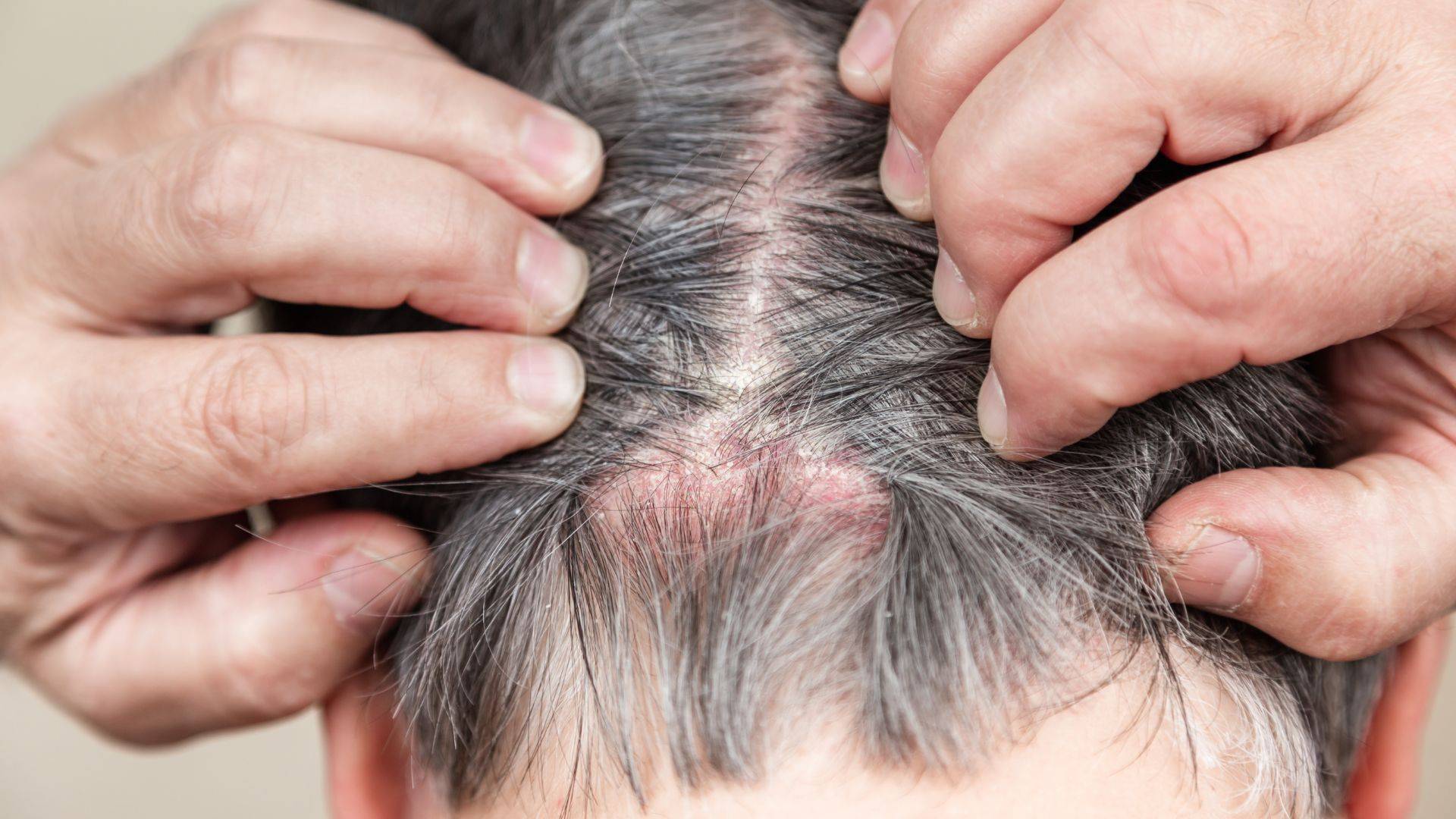 Alopecia por tiña del cuero cabelludo, ¿pueden contagiar los perros?