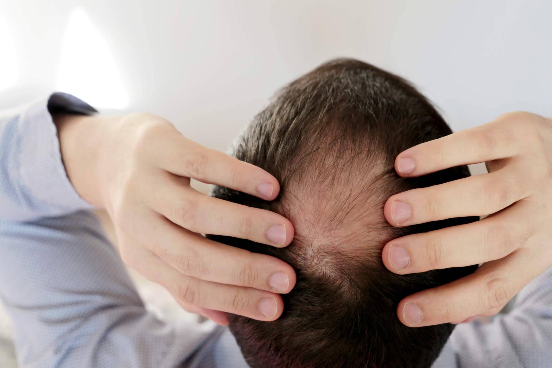 Trasplante de pelo en la coronilla, la solución definitiva para la alopecia en esta zona