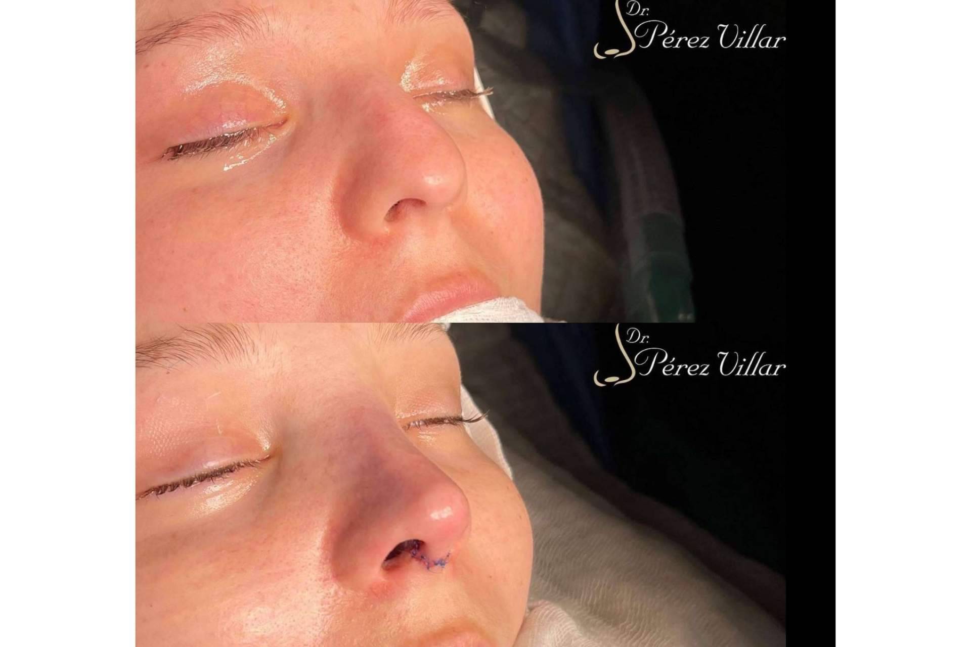 La rinoplastia ultrasónica de preservación es una técnica cada vez más presente en el mundo de la estética, por el Dr. Álvaro Pérez-Villar Bonet