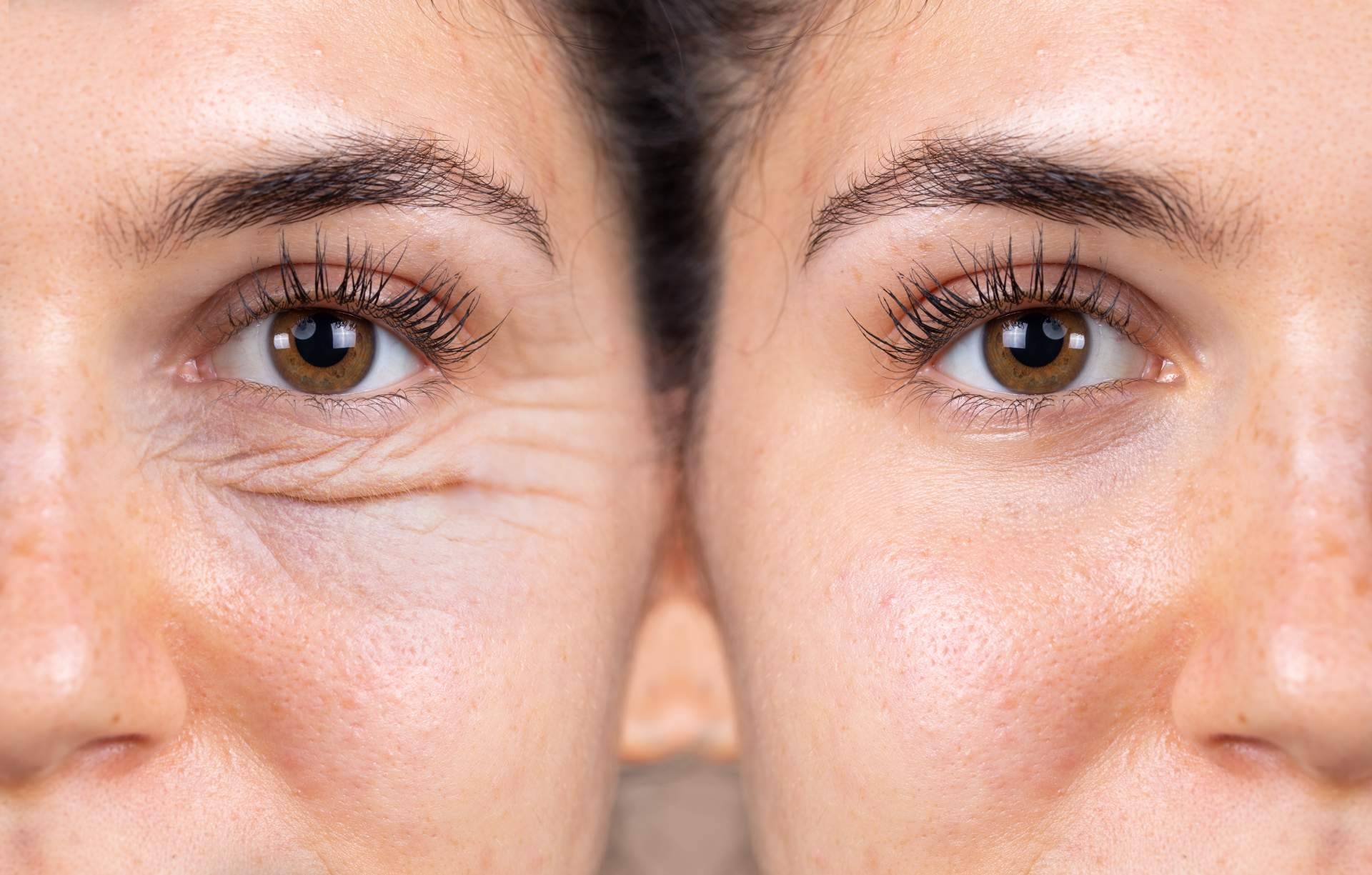 Alluring Clinic, ¿en qué consiste la blefaroplastia no quirúrgica?