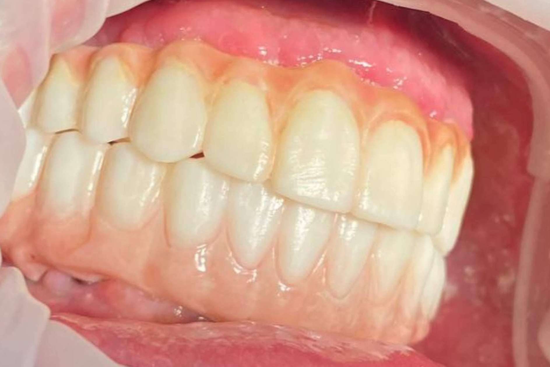 Dentinova aplica la impresión 3D para hacer posible los dientes en un día