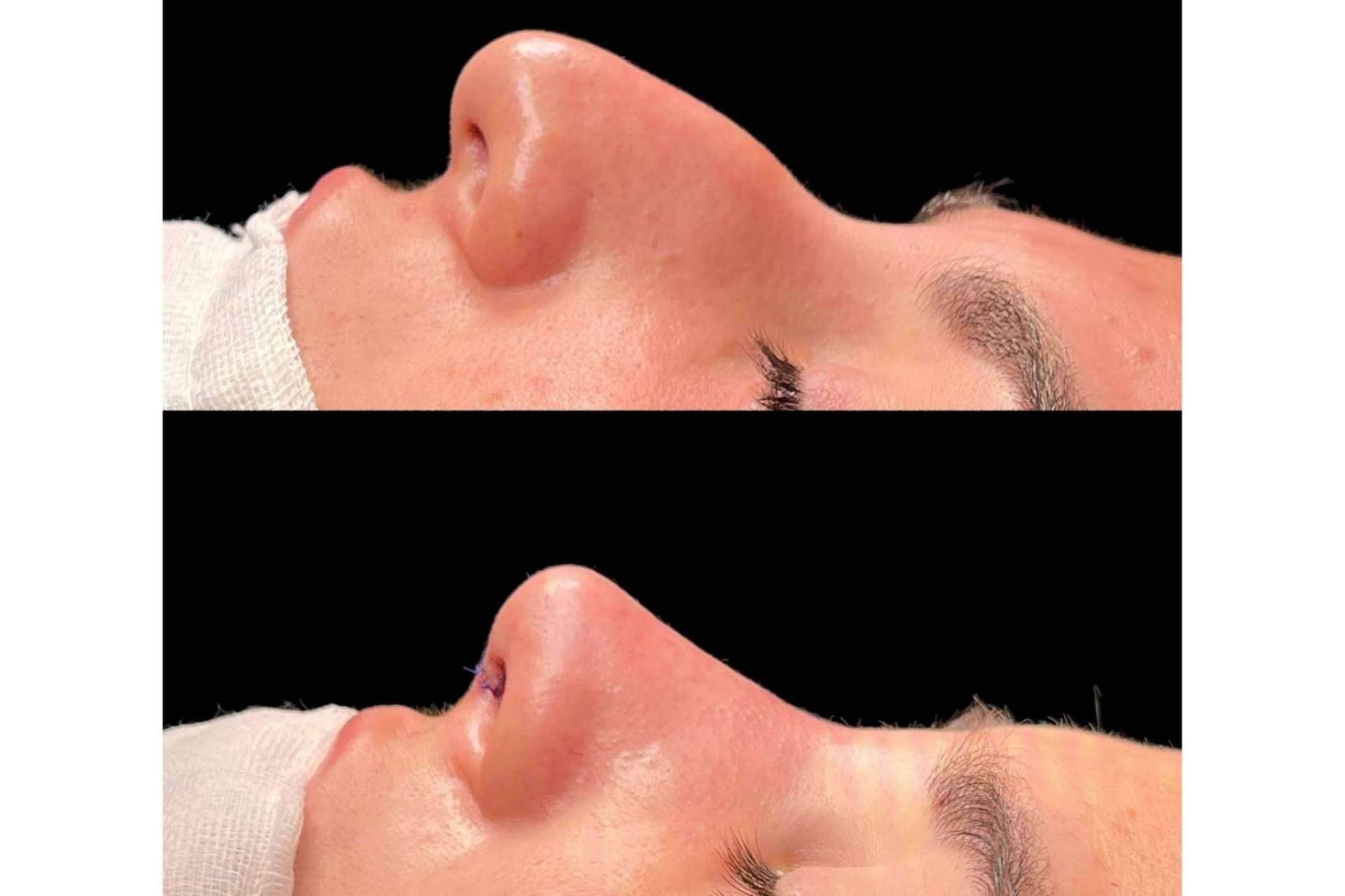 Cómo recuperarse de una rinoplastia, con el Dr. Pérez Villar