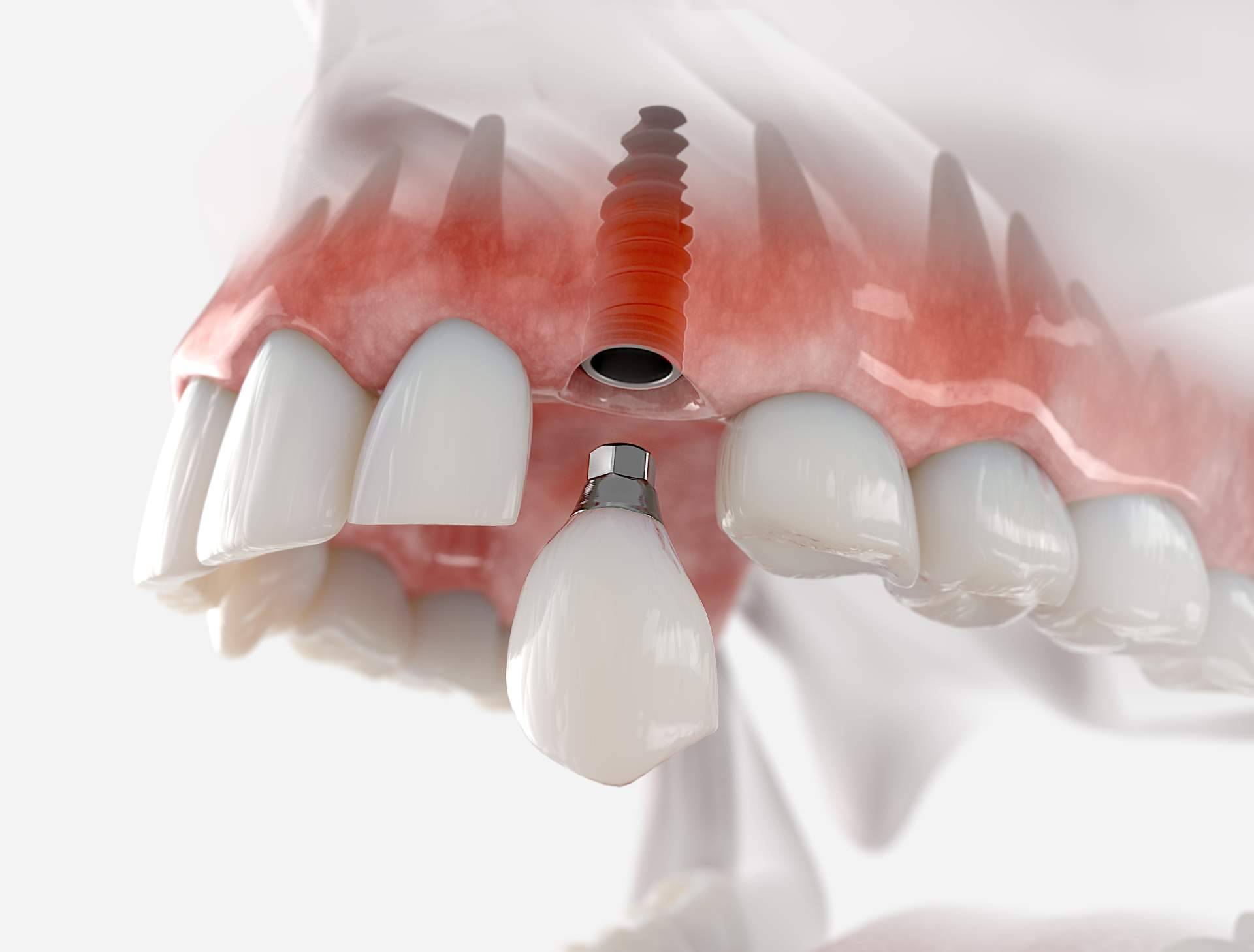 Dentinova, las consecuencias de la pérdida de un diente