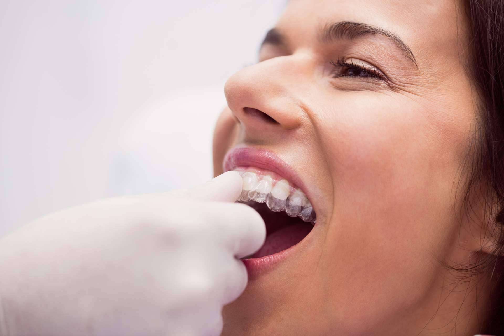 Toda la información sobre la ortodoncia para adultos, por Clínica Dental Delgado