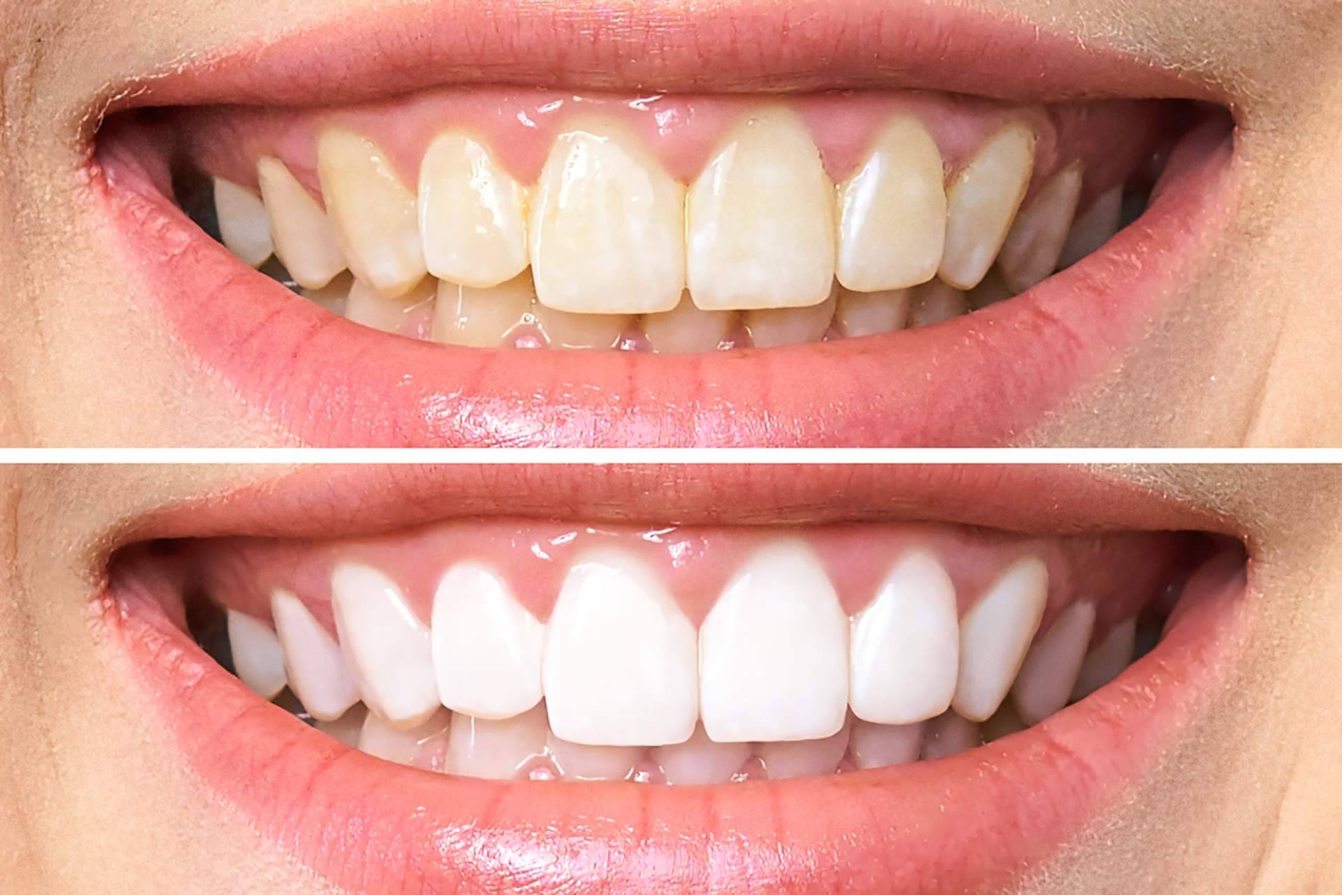 ¿Cómo se lleva a cabo un blanqueamiento dental?, por Clínica Dental Delgado