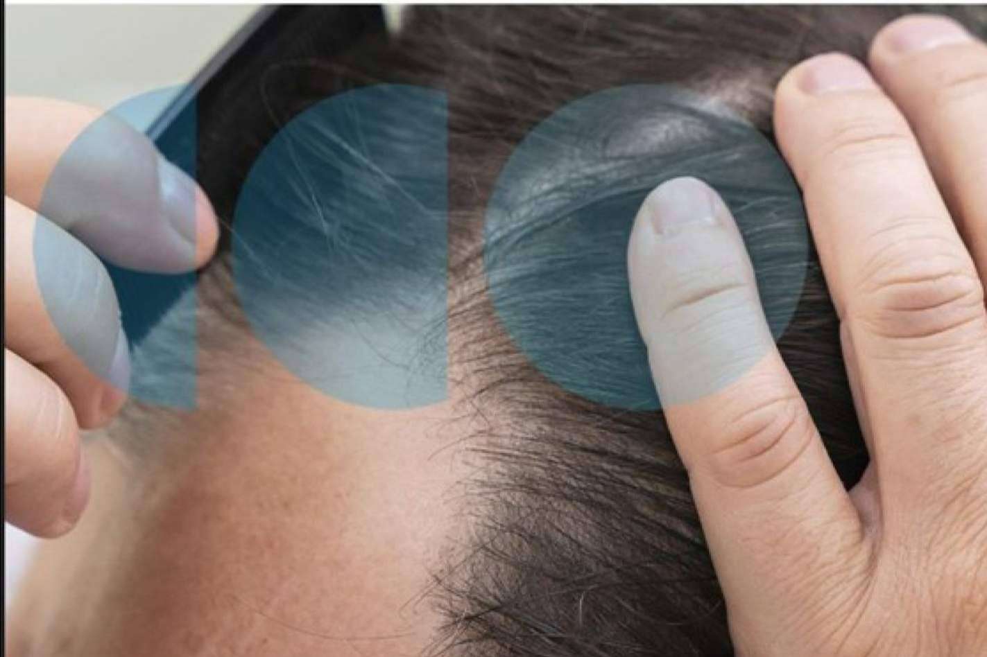 Este año la caída de cabello estacional viene más fuerte