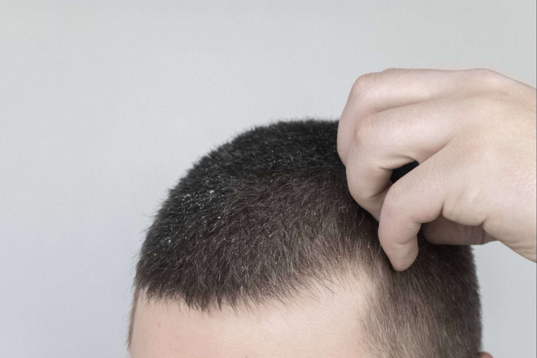 ¿Es culpable la caspa de la caída del cabello?