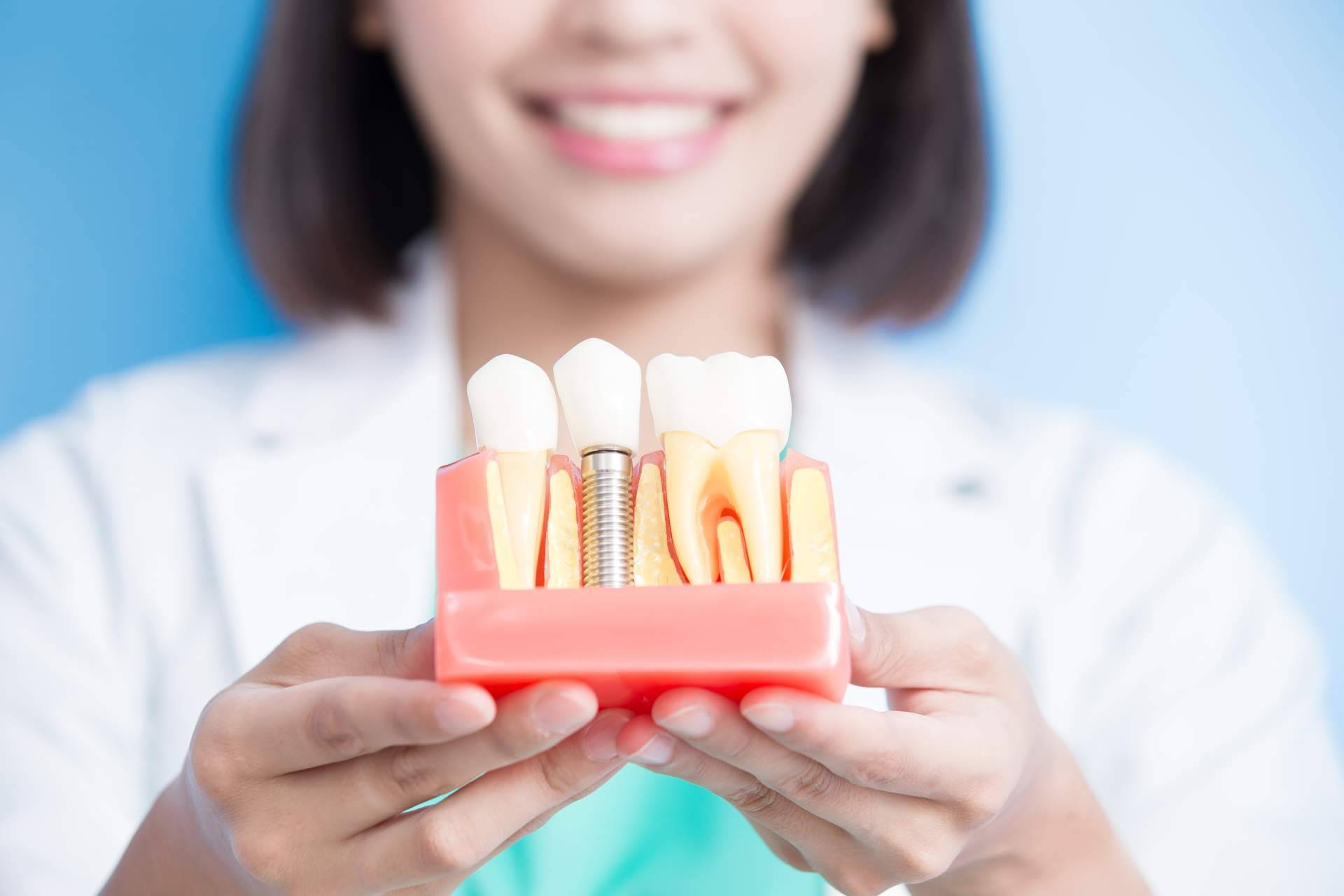 ¿Qué tipos de implantes dentales existen y cuáles se deben usar según cada caso?, por DeltaDent