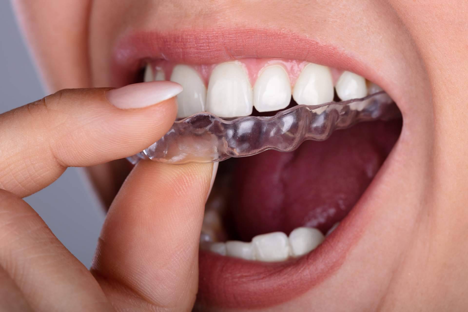 DrMouth ofrece implantes y tratamiento de ortodoncia